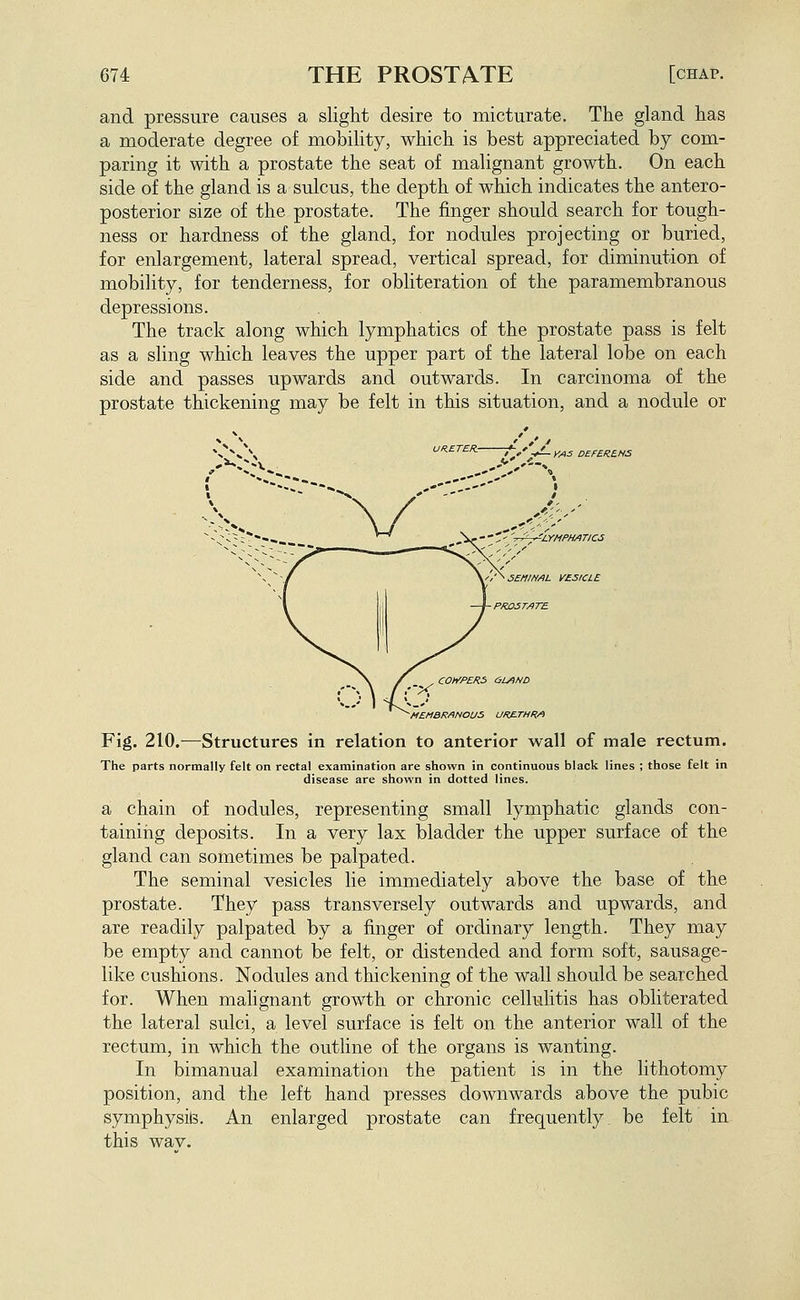 and pressure causes a slight desire to micturate. The gland has a moderate degree of mobility, which is best appreciated by com- paring it with a prostate the seat of malignant growth. On each side of the gland is a sulcus, the depth of which indicates the antero- posterior size of the prostate. The finger should search for tough- ness or hardness of the gland, for nodules projecting or buried, for enlargement, lateral spread, vertical spread, for diminution of mobility, for tenderness, for obliteration of the paramembranous depressions. The track along which lymphatics of the prostate pass is felt as a sling which leaves the upper part of the lateral lobe on each side and passes upwards and outwards. In carcinoma of the prostate thickening may be felt in this situation, and a nodule or :<-\ ,>'>^ SEMIN/iL VESICLE PR03T/ITE _ COh'PER5 OLfiND -MEMBRANOUS UR^THR/^ Fig. 210.-—Structures in relation to anterior wall of male rectum. The parts normally felt on rectal examination are shown in continuous black lines ; those felt in disease are shown in dotted lines. a chain of nodules, representing small lymphatic glands con- tainirig deposits. In a very lax bladder the upper surface of the gland can sometimes be palpated. The seminal vesicles lie immediately above the base of the prostate. They pass transversely outwards and upwards, and are readily palpated by a finger of ordinary length. They may be empty and cannot be felt, or distended and form soft, sausage- like cushions. Nodules and thickening of the wall should be searched for. When malignant growth or chronic cellulitis has obliterated the lateral sulci, a level surface is felt on the anterior wall of the rectum, in which the outline of the organs is wanting. In bimanual examination the patient is in the lithotomy position, and the left hand presses downwards above the pubic symphysite. An enlarged prostate can frequently be felt in this wav.