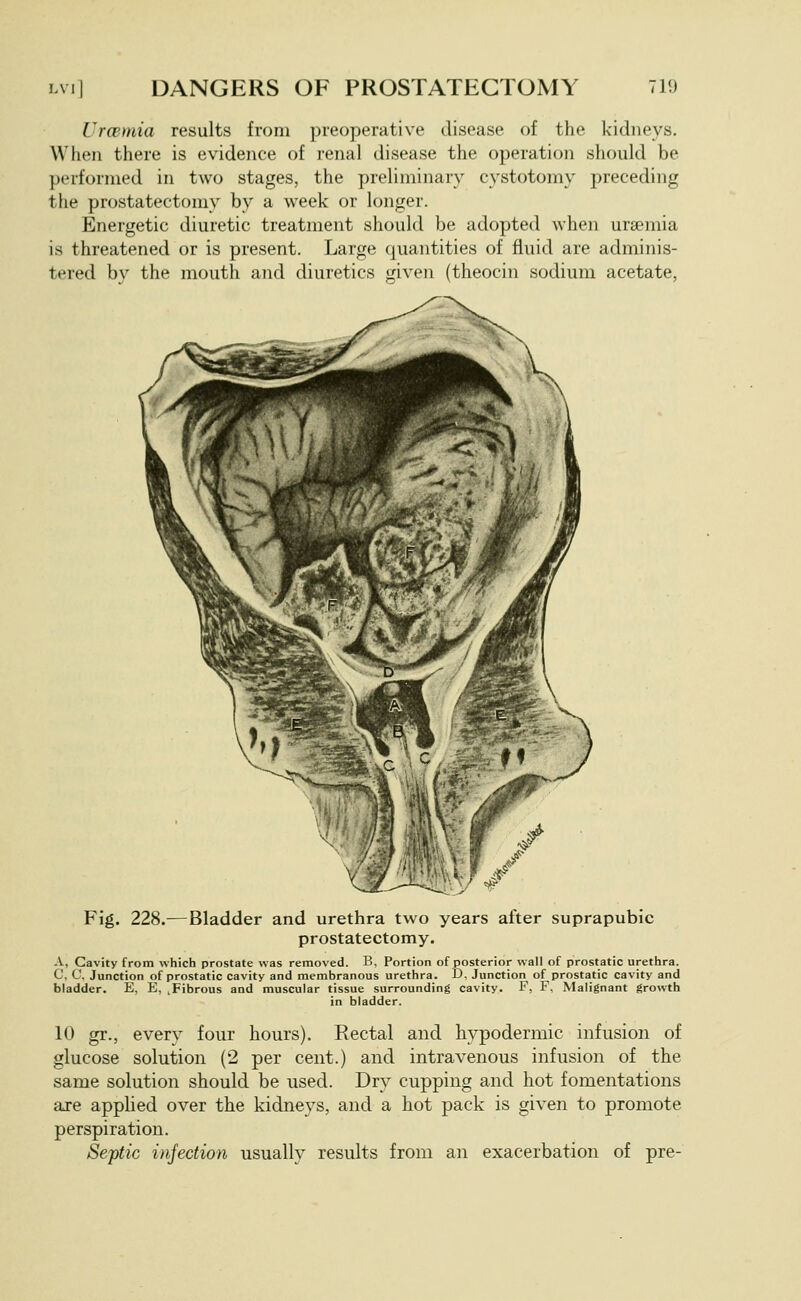 Urcemia results from preoperative disease of the kidneys. When there is evidence of renal disease the operation should be performed in two stages, the preliminary cystotomy preceding the prostatectomy by a week or longer. Energetic diuretic treatment should be adopted when urajmia is threatened or is present. Large quantities of fluid are adminis- tered bv the mouth and diuretics given (theocin sodium acetate, Fig. 228.^—Bladder and urethra two years after suprapubic prostatectomy. A, Cavity from which prostate was removed. B, Portion of posterior wall of prostatic urethra. C, C, Junction of prostatic cavity and membranous urethra. D, Junction of prostatic cavity and bladder. E, E, .Fibrous and muscular tissue surrounding cavity. F, F, Malignant growth in bladder. 10 gr., every four hours). Rectal and hypodermic infusion of glucose solution (2 per cent.) and intravenous infusion of the same solution should be used. Dry cupping and hot fomentations aje applied over the kidneys, and a hot pack is given to promote perspiration. Septic infection usually results from an exacerbation of pre-