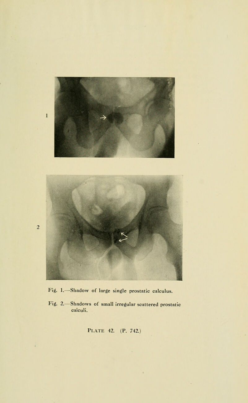 Fig. 1.—Shadow of large single prostatic calculus. Fig. 2.—Shadows of small irregular scattered prostatic calculi. Plate 42. (P. 742.