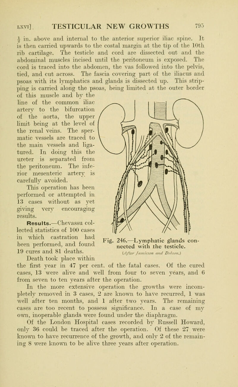 ^ in. above and internal to the anterior superior iliac spine. It is then carried upwards to the costal margin at the tip of the 10th rib cartilage. The testicle and cord are dissected out and the abdominal muscles incised until the peritoneum is exposed. The cord is traced into the abdomen, the vas followed into the pelvis, tied, and cut across. The fascia covering part of the iliacus and psoas with its lymphatics and glands is dissected up. This strip- ping is carried along the psoas, being limited at the outer border of this muscle and by the line of the common iliac artery to the bifurcation of the aorta, the upper limit being at the level of the renal veins. The sper- matic vessels are traced to the main vessels and liga- tured. In doing this the ureter is separated from the peritoneum. The infe- rior mesenteric artery is carefully avoided. Tliis operation has been performed or attempted in 13 cases without as yet giving very encouraging results. Results.—Chevassu col- lected statistics of 100 cases in which castration had been performed, and fomid 19 cures and 81 deaths. Death took place within the first year in 47 per cent, of the fatal cases. Of the cured cases, 13 were alive and well from four to seven years, and 6 from seven to ten years after the operation. In the more extensive operation the growths were incom- pletely removed in 3 cases, 2 are known to have recurred, 1 was well after ten months, and 1 after two years. The remaining cases are too recent to possess significance. In a case of my own, inoperable glands were found under the diaphragm. Of the London Hospital cases recorded by Eussell Howard, only 36 could be traced after the operation. Of these 27 were known to have recurrence of the growth, and only 2 of the remain- ing 8 were known to be ahve three years after operation. Fig. 246.^—Lymphatic glands con- nected with the testicle. {After Jainicsoii and Dohsoii.)