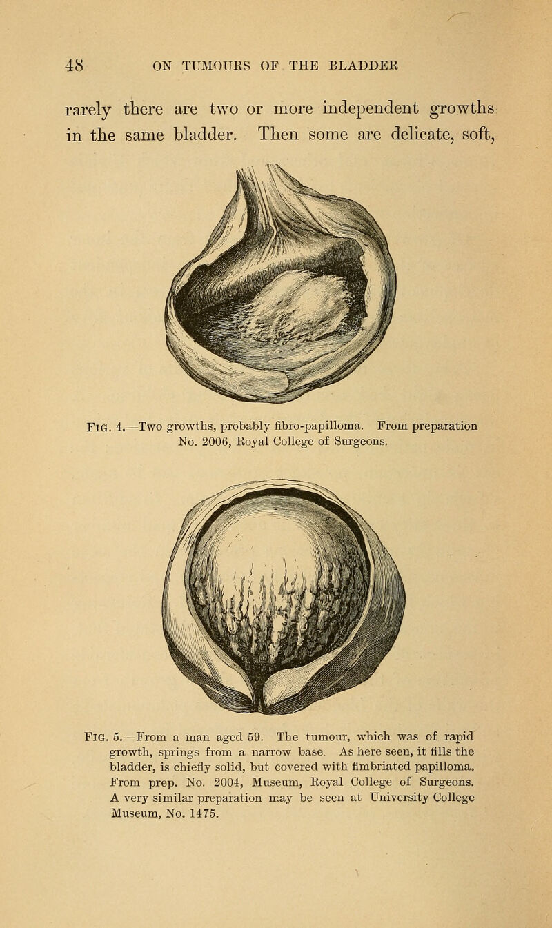 rarely tbere are two or more independent growths in the same bladder. Then some are delicate, soft, Fig. 4.—Two growths, probably fibro-papilloma. From preparation No. 2006, Royal College of Surgeons. Fig. 5.—From a man aged 59. The tumour, which was of rapid growth, springs from a narrow base. As here seen, it iills the bladder, is chiefly solid, but covered with fimbriated papilloma. From prep. No. 200i, Museum, Royal College of Surgeons. A very similar preparation may be seen at University College Museum, No. 1475.