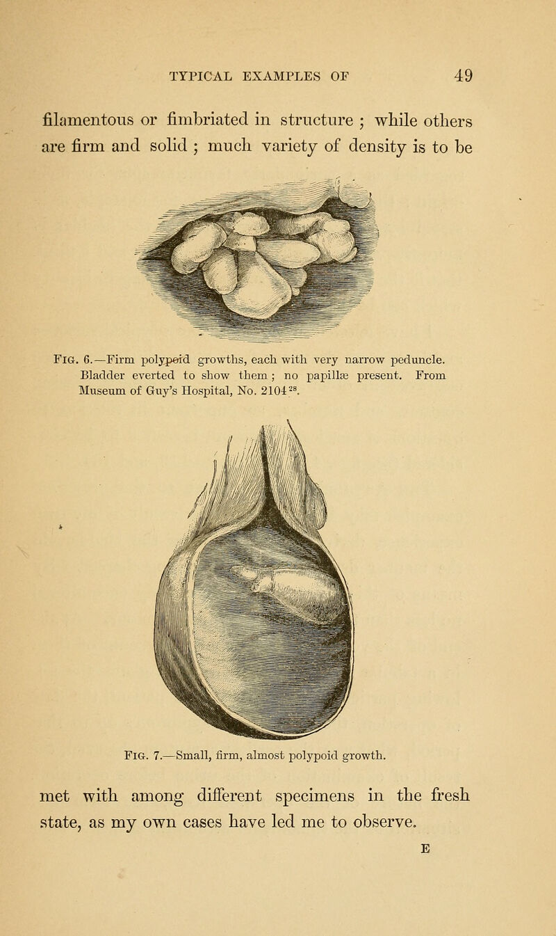 filamentous or fimbriated in structure ; while others are firm and solid ; much variety of density is to be Fig. 6.—Firm polypeid growths, each with very narrow peduncle. Bladder everted to show them; no papillte present. From Museum of Guy's Hospital, No. 2104^8. Fig. 7.—Small, firm, almost polypoid growth. met with among different specimens in the fi:'esh state, as my own cases have led me to observe. E