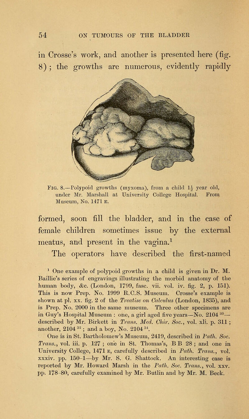 in Crosse's work, and another is presented here (fig. 8) ; the growths are numerous, evidently rapidly Fig. 8.—Poljpoid growths (myxoma), from a child 1^ year old, under Mr. Marshall at University College Hospital. From. Museum, No. 1471 E. formed, soon fill the bladder, and in the case of female children sometimes issue by the external meatus, and present in the vagina.^ The operators have described the first-named ^ One example of polypoid growths in a child is given in Dr. M. Baillie's series of engravings illustrating the morbid anatomy of the human body, &c. (London, 1799, fasc. vii. vol. iv. fig. 2, p. 151). This is now Prep. No. 1999 R.C.S. Museum. Crosse's example is shown at pi. xx. fig. 2 of the Treatise on Calculus (London, 1835), and is Prep. No. 2000 in the same museum. Three other specimens are in Guy's Hospital Museum : one, a girl aged five years—No. 2104 ^°— described by Mr. Birkett in Trans. Med. Chir. Soc, vol. xli. p. 311; another, 2104 ^2; and a boy, No. 2104 ^\ One is in St. Bartholomew's Museum, 2419, described in Fath. Soc. Trans., vol. iii. p. 127 ; one in St. Thomas's, B B 28 ; and one in University College, 1471 e, carefully described in Path. Trans., vol. xxxiv. pp. 150-1—by Mr. S. Gr. Shattock. An interesting case is reported by Mr. Howard Marsh in the Path. Soc. Trans., vol. xxv. pp. 178-80, carefully examined by Mr. Butlin and by Mr. M. Beck.