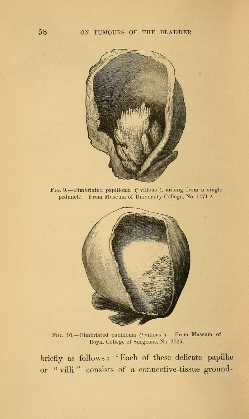 Fig. 9.—Fimbriated papilloma (' villous'), arising from a single peduncle. From Museum of University College, No. 1471 A. Fig. 10.—Fimbriated papilloma ('villous')- From Museum of Eoyal College of Surgeons, No. 2005. briefly as follows : ' Each of these delicate papilla3 or  villi  consists of a connective-tissue ground-