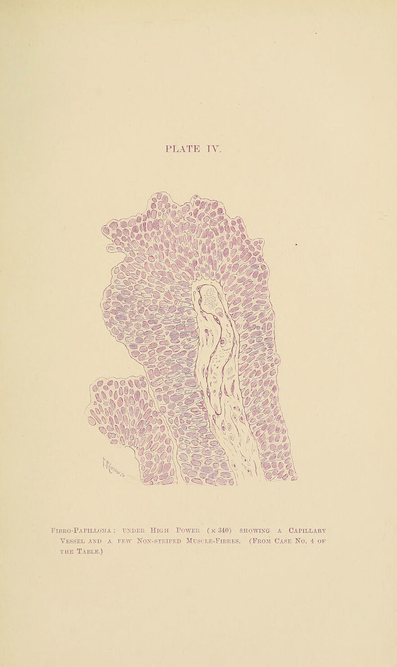 ■>isf»(' J* V&f %K. -i ^^jrVi^tj FiBEo-PAriLLOJiA: rxnEK Hien Powek (x340) showing a Capillary Vessel axd a tew No'-stkiped Muscle-Fibres. (Fbom Case No. 4 of THE Table.)