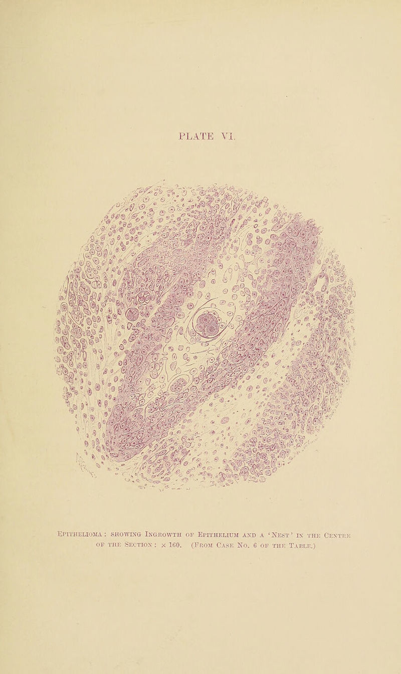 / '# m \ 1 V ,1 \? «• . ' .liifs m^' :3 Epithelioma : showixg Ingrowth of Epithelium axd a ' Nest ' ix 'i'hk Cextiik