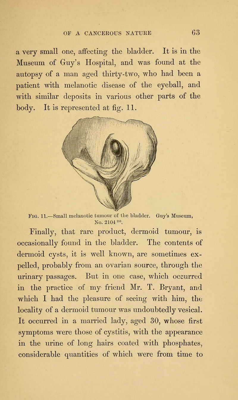 OE A CANCEROUS NATURE G3 a very small one, affecting the bladder. It is in the Museum of Guy's Hospital, and was found at the autopsy of a man aged thirty-two, who had been a patient with melanotic disease of the eyeball, and with similar deposits in various other parts of the body. It is represented at fig. 11. Fig. 11.—Small melanotic tumour of the bladder. Guy's Museum, No. 210^2°. Finally, that rare product, dermoid tumour, is occasionally found in the bladder. The contents of dermoid cysts, it is well known, are sometimes ex- pelled, probably from an ovarian source, through the urinary passages. But in one case, which occurred in the practice of my friend Mr. T. Bryant, and which I had the pleasure of seeing with him, the locality of a dermoid tumour was undoubtedly vesical. It occurred in a married lady, aged 30, whose first symptoms were those of cystitis, with the appearance in the urine of long hairs coated with phosphates, considerable quantities of which were from time to