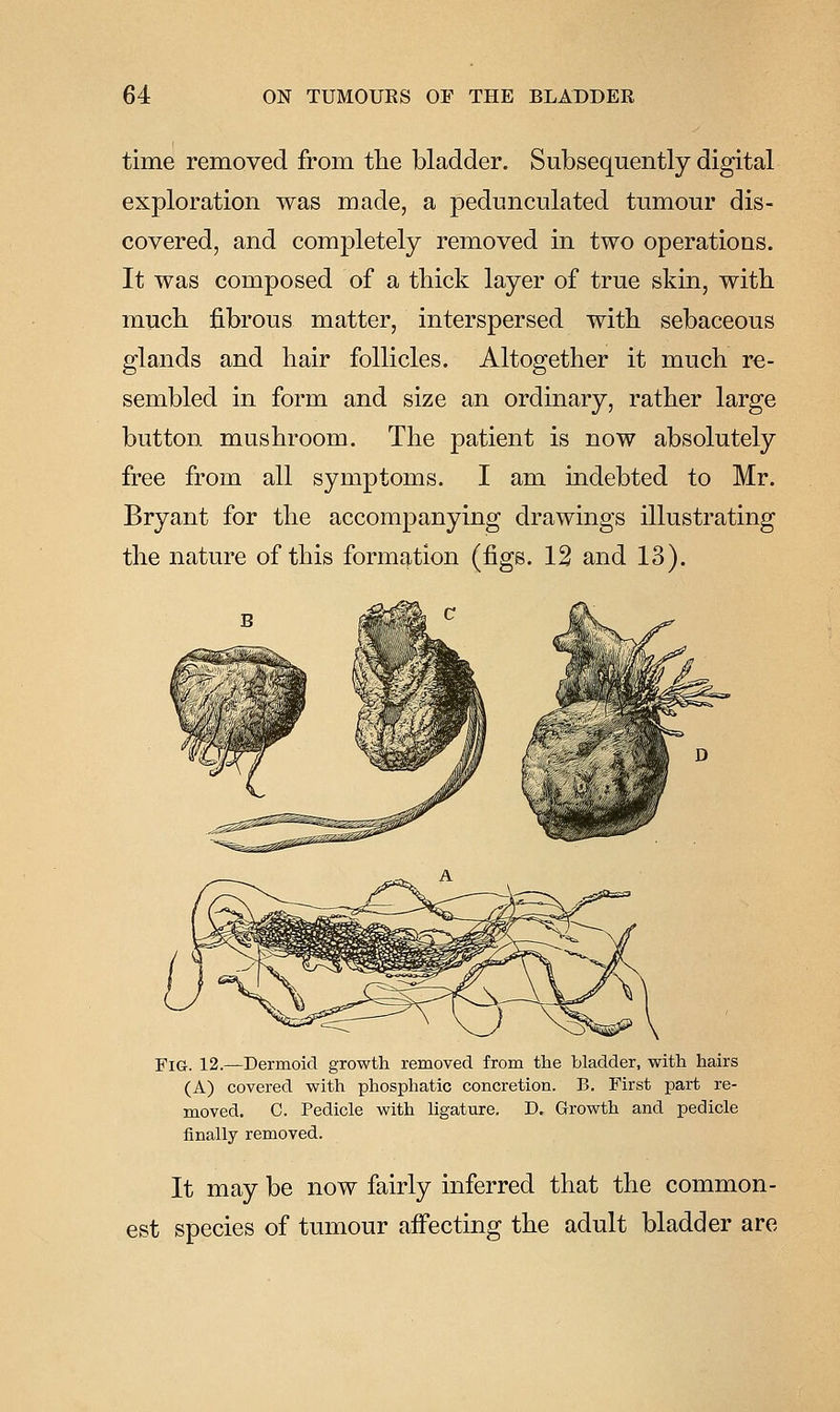 time removed from tlie bladder. Subsequently digital exploration was made, a pedunculated tumour dis- covered, and completely removed in two operations. It was composed of a tbick layer of true skin, witb mucb fibrous matter, interspersed witb sebaceous glands and bair follicles. Altogetber it much re- sembled in form and size an ordinary, ratber large button musbroom. Tbe patient is now absolutely free from all symptoms. I am indebted to Mr. Bryant for tbe accompanying drawings illustrating tbe nature of this formation (figs. 12 and 13). ■o.y^ Fig. 12.—Dermoid growth removed from the bladder, with hairs (A) covered with phosphatic concretion. B. First part re- moved. C. Pedicle with ligature. D. Growth and pedicle finally removed. It may be now fairly inferred tbat tbe common- est species of tumour affecting tbe adult bladder are