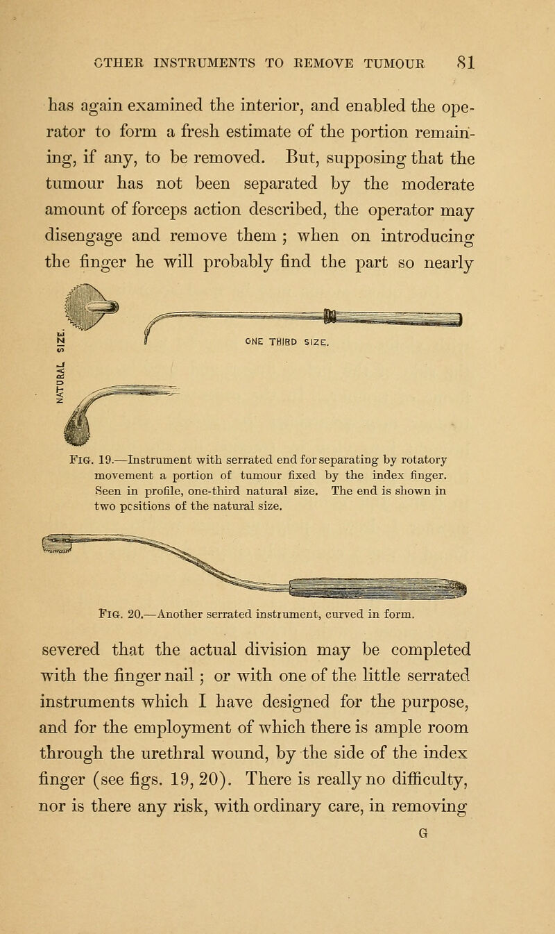 has again examined the interior, and enabled the ope- rator to form a fresh estimate of the portion remain- ing, if any, to be removed. But, supposing that the tumour has not been separated by the moderate amount of forceps action described, the operator may disengage and remove them ; when on introducing the finger he will probably find the part so nearly Fig-. 19.—Instrument with serrated end for separating by rotatory- movement a portion of tumour fixed by the index finger. Seen in profile, one-third natural size. The end is shown in two positions of the natural size. Fig. 20.—Another serrated instrument, curved in form. severed that the actual division may be completed with the finger nail; or with one of the little serrated instruments which I have designed for the purpose, and for the employment of which there is ample room through the urethral wound, by the side of the index finger (see figs. 19, 20). There is really no difficulty, nor is there any risk, with ordinary care, in removing G