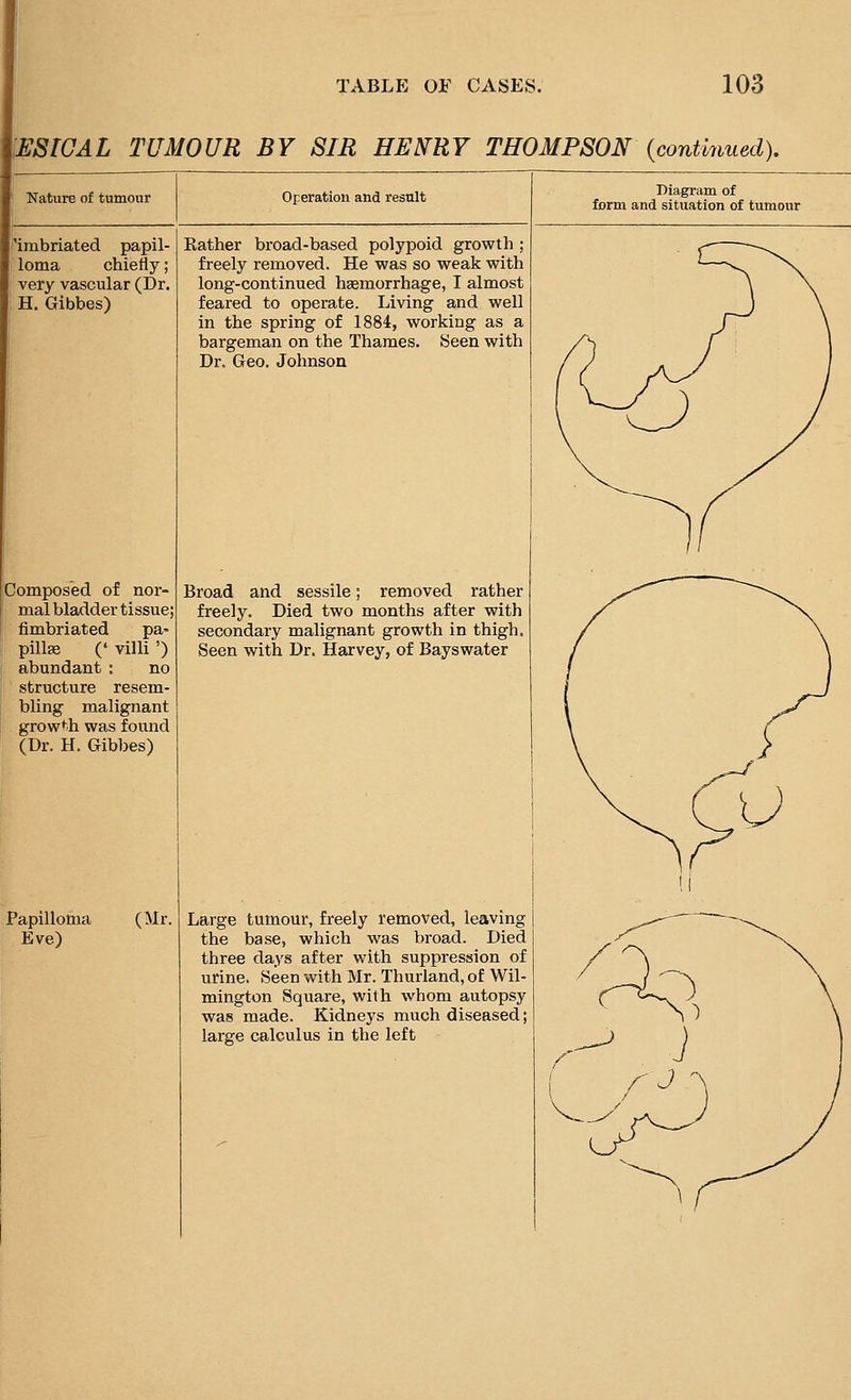 VESICAL TUMOUR BY SIR HENRY THOMPSON {continued). Nature of tumour Operation and result Diagram of form and situation of tumour 'imbriated papil- loma chiefly; very vascular (Dr. H. Gibbes) Composed of nor- mal bladder tissue; fimbriated pa- pilla (' villi ') abundant : no structure resem- bling malignant growth was found (Dr. H. Gibbes) Papilloma Eve) (Mr. Rather broad-based polypoid growth ; freely removed. He was so weak with long-continued haemorrhage, I almost feared to operate. Living and well in the spring of 1884, working as a bargeman on the Thames. Seen with Dr. Geo. Johnson Broad and sessile; removed rather freely. Died two months after with secondary malignant growth in thigh. Seen with Dr. Harvey, of Bayswater Large tumour, freely removed, leaving the base, which was broad. Died three days after with suppression of urine. Seen with Mr. Thurland, of Wil- mington Square, with whom autopsy was made. Kidneys much diseased; large calculus in the left