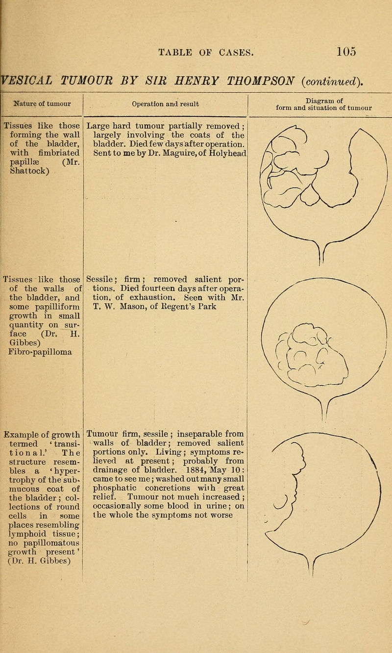 VESICAL TUMOUR BY SIR HENRY THOMPSON {continued). Nature of tumour Operation and result Diagram of form and situation of tumour Tissues like those forming the wall of the bladder, with fimbriated papillae (Mr. Shattock) Tissues like those of the walls of the bladder, and some papilliform growth in small quantity on sur- face (Dr. H. Gibbes) Fibro-papilloma Example of growth termed ' transi- tional.' The structure resem- bles a ' hyper- trophy of the sub- mucous coat of the bladder; col- lections of round cells in some places resembling lymphoid tissue; no papillomatous growth present' (Dr. H. Gibbes) Large hard tumour partially removed ; largely involving the coats of the bladder. Died few days after operation. Sent to me by Dr. Maguire, of Holyhead Sessile; firm; removed salient por- tions. Died fourteen days after opera- tion, of exhaustion. Seen with Mr. T. W. Mason, of Regent's Park Tumour firm, sessile ; inseparable from walls of bladder; removed salient portions only. Living; symptoms re- lieved at present; probably from drainage of bladder. 1884, May 10: came to see me; washed out many small phosphatic concretions wiih great relief. Tumour not much increased ; occasiorally some blood in urine; on the whole the symptoms not worse