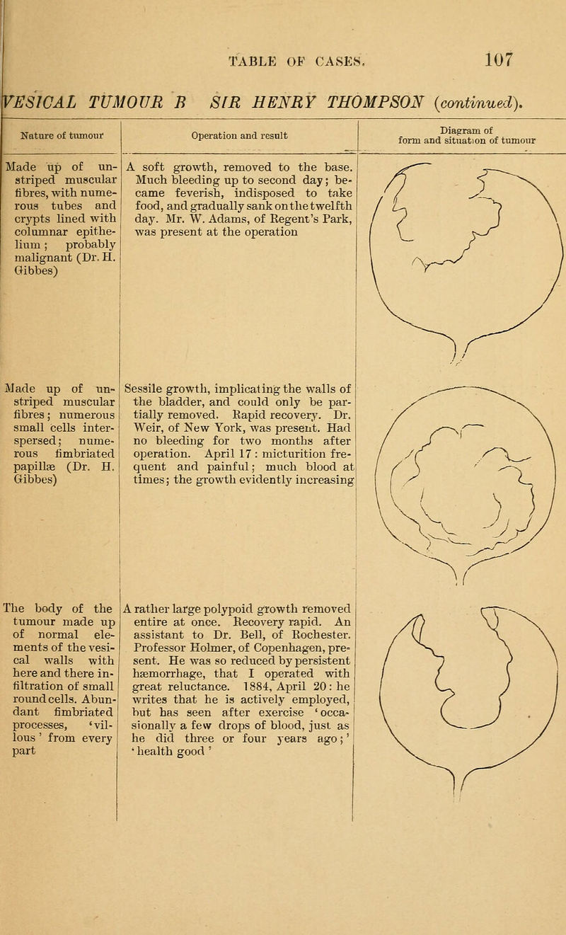 VESICAL TUMOUR B SfE HENRY THOMPSON {contvnued). Nature of tumour Made up of un- striped muscular fibres, with nume- rous tubes and crypts lined with columnar epithe- lium ; probably malignant (Dr. H. Gibbes) Made up of un» striped muscular fibres; numerous small cells inter- spersed; nume- rous fimbriated papillfB (Dr, H. Gibbes) The body of the tumour made up of normal ele- ments of the vesi- cal walls with here and there in- filtration of small round cells. Abun- dant fimbriated processes, 'vil- lous ' from every part Operation and result A soft growth, removed to the base. Much bleeding up to second day; be- came feverish, indisposed to take food, and gradually sank on the twelfth day. Mr. W. Adams, of Regent's Park, was present at the operation Diagram of form and situation of tumour Sessile growth, implicating the walls of the bladder, and could only be par- tially removed. Rapid recover^'. Dr. Weir, of New York, was present. Had no bleeding for two months after operation. April 17 : micturition fre- quent and painful; much blood at times; the growth evidently increasing A rather large polypoid growth removed entire at once. Recovery rapid. An assistant to Dr. Bell, of Rochester. Professor Holmer, of Copenhagen, pre- sent. He was so reduced by persistent hemorrhage, that I operated with great reluctance. 1884, April 20 : he writes that he is actively employed, but has seen after exercise ' occa- sionally a few drops of blood, just as he did three or four years ago;' ' health good '