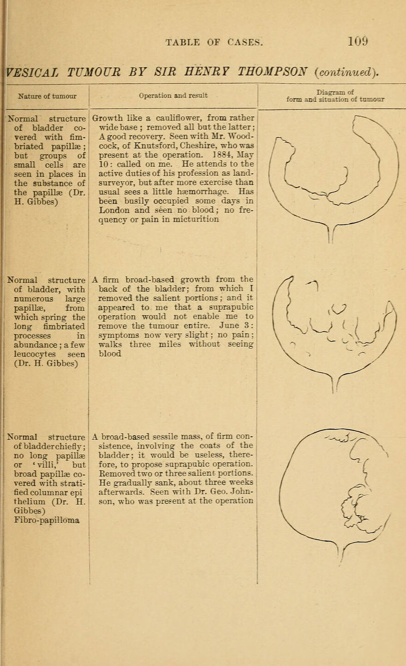 VESICAL TUMOUR BY SIR HENRY THOMPSON (continued). Nature of tumour Operation and result Diagram of form and situation of tnmour Normal structure of bladder co- vered with fim- briated papillee; but groups of small cells are seen in places in the substance of the papillae (Dr. H. Gibbes) Growth like a cauliflower, from rather i wide base ; removed all but the latter; I A good recovery. Seen with Mr. Wood- j cock, of Knutsford, Cheshire, who was present at the operation. 1884, ilav 10 : called on me. He attends to the active duties of his profession as land-, surveyor, but after more exercise than usual sees a little hgemorrhage. Has been busily occupied some days in \ London and seen no blood: no fre-! quency or pain in micturition [ Normal structure A firm broad-based growth from the of bladder, with back of the bladder: from which I numerous large removed the salient portions; and it papillae, from; appeared to me that a suprapubic which spring the | operation would not enable me to long fimbriated: remove the tumour entire. June 3: processes in ' symptoms now very slight; no pain: abundance; a few walks three miles without seeing leucocytes seen blood (Dr. H. Gibbes) ; Normal structure of bladderchiefly; no long papillae or ' villi,' but broad papUls co- vered with strati- fied columnar epi thelium (Dr. H. Gibbes) Fibro -papilloma A broad-based sessile mass, of firm con- [ sistence, involving the coats of the bladder; it would be useless, there-1 ; fore, to propose suprapubic operation. , Eemoved two or three salient portions. | He gradually sank, about three weeks i afterwards. Seen with Dr. Geo. .John- son, who was present at the operation
