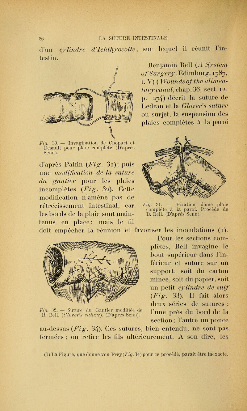 d'un cylindre d'Ichthyocolle, sur lequel il réunit l'in- testin. Benjamin Bell (A System ofSurgery, Edimburg, 1787, t. V) (Woundsofthealimen- tarycanal,chap.36, sect. 12, p. 274) décrit la suture de Ledran et la Glover's suture ou surjet, la suspension des plaies complètes à la paroi Fig. 30. — Invagination de Chopart et Desault pour plaie complète. (D'après Senn). d'après Palfin (Fig. 3i); puis une modification de la suture du gantier pour les plaies incomplètes (Fig. 3a). Cette modification n'amène pas de rétrécissement intestinal, car les bords de la plaie sont main- tenus en place ; mais le lil doit empêcher la réunion et favoriser les inoculations (1). Pour les sections com- plètes, Bell invagine le bout supérieur dans l'in- férieur et suture sur un support, soit du carton mince, soit du papier, soit un petit cylindre de suif (Fig. 33). Il fait alors deux séries de sutures : l'une près du bord de la section; l'autre un pouce au-dessus (Fig. 34). Ces sutures, bien entendu, ne sont pas fermées ; on retire les fils ultérieurement. A son dire, les Fig. 31. — Fixation d'une plaie complète à la paroi. Procède de B. Bell. (D'après Senn). Fig. 32. — Suture du Gantier modifiée de B. Bell. (Glover's suture). (D'après Senn). (1) La Figure, que donne von Frey (Fig. 14) pour ce procédé, paraît être inexacte.