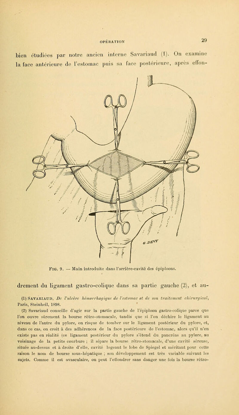 OPlîllATION bien étudiùes par notre aiiciou iiil,(uii(i Savariaud (1). On examine la face antérieure de l'estomac puis sa face postérieure, après ell'on- FlG. 9. — Main introduite dans l'arrière-cavité des épiploons. drement du ligament gastro-colique dans sa partie gauche (2), et au- (1) SAVAEIAUD. De l'ulcère liémorrlmgique de l'estomac et de son traitement chirurgical, Paris, Steinheil, 1898. ' (2) Savariaud conseille d'agir sur la partie gauche de l'épiploon gastro-eolique parce que l'on ouvre sûrement la bourse rétro-stomacale, tandis que si l'on déchire le ligament au niveau de l'antre du pylore, on risque de tomber sur le ligament postérieur du pylore, et, dans ce cas, on croit à des adhérences de la face postérieure de l'estomac, alors qu'il n'en existe pas en réalité (ce ligament postérieur du pylore s'étend du pancréas au pylore, au voisinage de la petite courbure ; il sépare la bourse rétro-stomacale, d'une cavité séreuse, située au-dessus et à droite d'elle, cavité logeant le lobe de Spiegel et méritant pour cette raison le nom de bourse sous-bépatique ; sou développement est trf's variable suivant les sujets. Comme il est avasculaire, on peut l'effondrer sans danger une fois la bourse rétro-