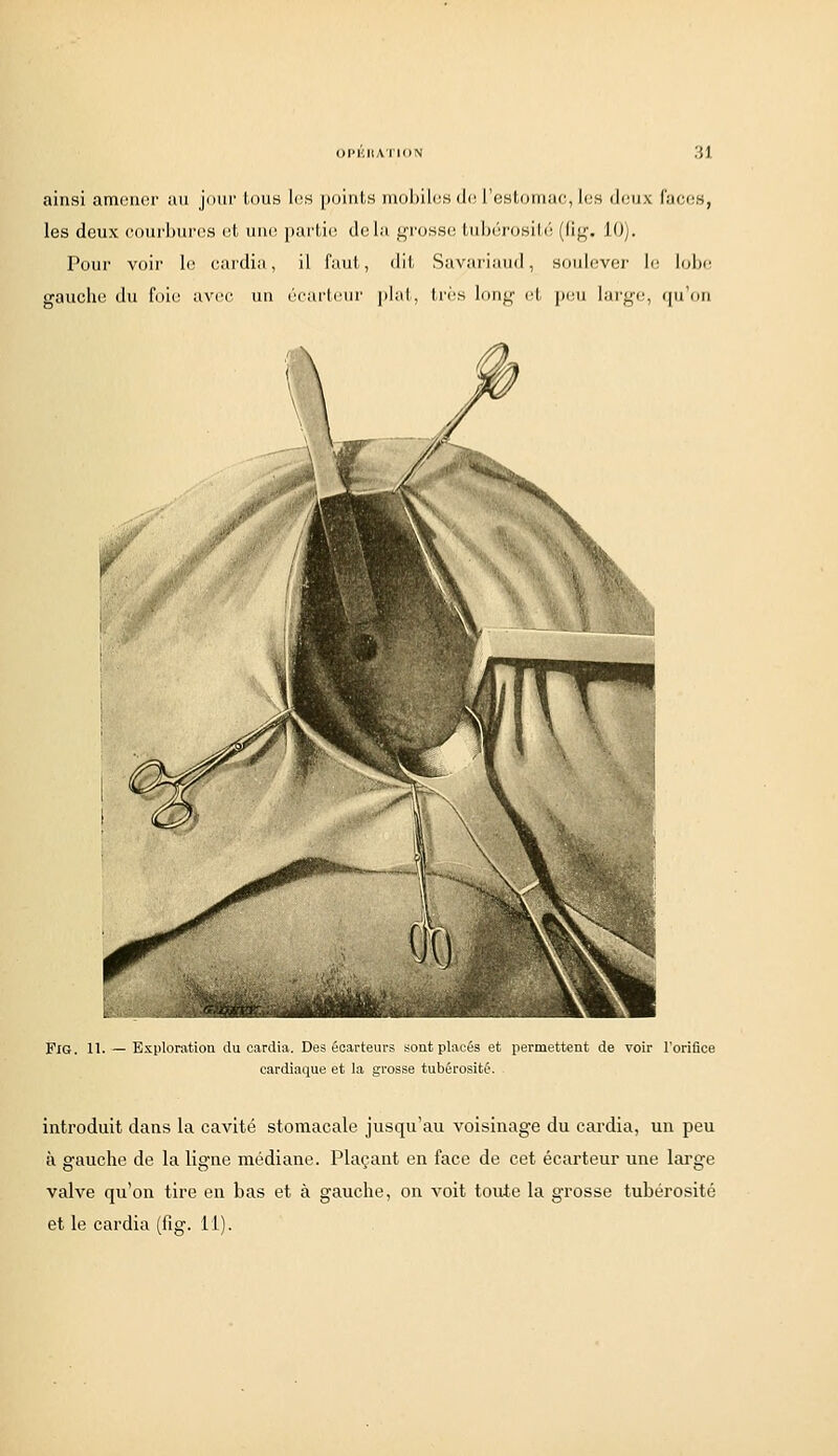 OPHIIATION ainsi amener au jour tous les points mol)ilos de. l'estomac, les deux faces, les deux eourburos et une partie delà grosse tubérosilé (fig. 10). Pour voir le eaidia, il faut, dit Savariand, soulevo]' le Itdje gauche du foie avec un écarlcur |ilal, Irrs long et peu laif^c, (pi'uri FiG. 11. — Exploration du cardia. Des écarteurs sont placés et permettent de voir l'oriflce cardiaque et la grosse tubérosité. introduit dans la cavité stomacale jusqu'au voisinage du cardia, un peu à gauche de la ligne médiane. Plaçant en face de cet écarteur une large valve qu'on tire en bas et à gauche, on voit toute la grosse tubérosité et le cardia (fig. 11).