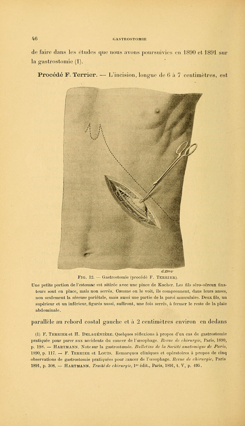 de faire clans les études (jue nous avons pinirsuivies en 1890 et 1891 sur la gastrostomie (1). Procédé F. Terrier. — L'incision, lono-ue de 6 à 7 centimètres, est L: C:Drvi' FiG. 12. — Gastrostomie (procédé F. Tereiee). Une petite portion de l'estomac est attirée avec une pince de Kocher. Les fils séro-séreux fixa- teurs sont en place, mais non serrés. Comme on le voit, ils comprennent, dans leurs anses, non seulement la séreuse pariétale, mais aussi une partie de la paroi musculaire. Deux fils, un supérieur et un inférieur, figurés aussi, suffiront, une fois serrés, à fermer le reste de la plaie abdominale. parallèle au rebord costal gauche et à 2 centimètres en\dron en dedans (1) F. Terrier et H. Delaobnièrb. Quelques réflexions à propos d'un cas de gastrostomie pratiquée pour parer aux accidents du cancer de l'œsophage. Revue de chirurgie, Paris, 1890, p. 198. — Hartmann. Note sur la gastrostomie. Bulletins de la Société anatomiqne de Paris, 1890, p. 117. — F. Tereiee et Louis. Remarques cliniques et opératoires il propos de cinq observations de gastrostomie pratiquées pour cancer de l'œsophage. Bévue de chirurgie, Paris 1891, p. 308. — Hartmann. Traité de chirurgie, 1« édit., Paris, 1891, t. V, p. 495.