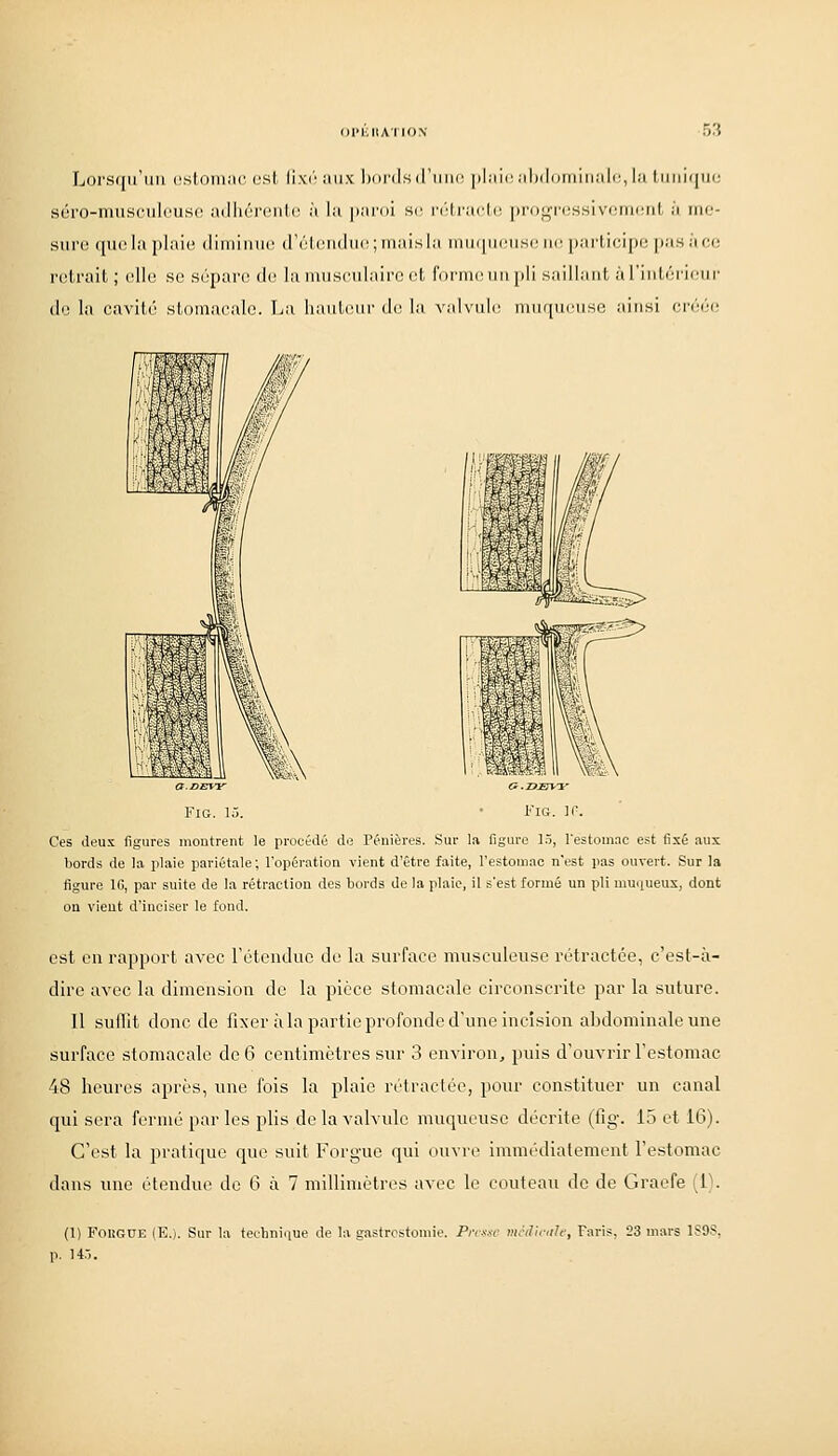 (ll'IillAI 10\ ',:>, Lors({irmi ('.sloiiuic. est lixi' iiiix liurdsil'iiiir |)l:iir jlnlnininiili', l:i tiiiii(|iii; sôro-musciileuse adhurento à la |iai'oi se i(Mrarl(; progre.ssivorncrit à me- sure qucla plaie diminue d'éLeudu(';iuaislM niii(|iii'iisc ne participe pas à co retrait ; elle se sépare de lamusoulain: cl, foiniciiii pli saillant àriiitoiicui- (le la cavité stomacale. T^a liauti^iir d(^ la valvule iiiiupicnse ainsi t:v('rf FiG. 15. Ces deux figures montrent le procédé de Pénières. Sur la figure l.ï, l'estomac est fixé aux bords de la plaie pariétale; l'opération vient d'être faite, l'estomac n'est pas ouvert. Sur la figure 16, par suite de la rétraction des bords de la plaie, il s'est formé un pli mmiueux, dont ou vieut d'inciser le fond. est en rapport avec retendue de la surface musculeuse rétractée, c'est-à- dire avec la dimension de la pièce stomacale circonscrite par la suture. Il suflit donc de fixer à la partie profonde d'une incision abdominale une surface stomacale de 6 centimètres sur 3 environ, puis d'ouvrir l'estomac 48 heures après, une fois la plaie rctracléo, pour constituer un canal qui sera fermé parles plis de la valvule muqueuse décrite (fig. 15 et 16). C'est la pratique que suit Forgue qui ouvre immédiatement l'estomac dans une étendue de 6 à 7 millimètres avec le couteau de de Graefe (P. (1) Fougue (E.i. Sur la techniiiue de la gastrostoniie. P;v.«c màlinih, Paris, 23 mars 1S9S, p. H.-).