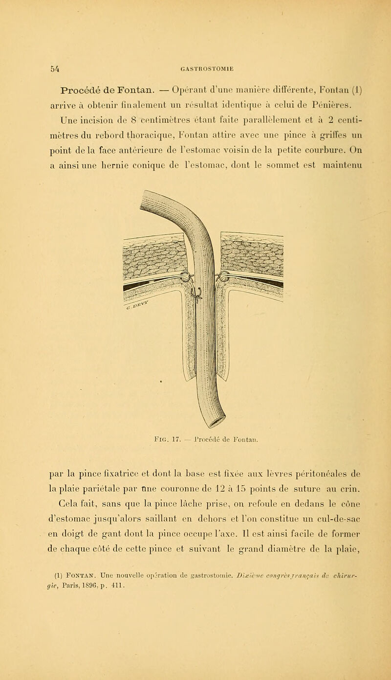 Procédé de Fontan. — Oin-raiit d'uiu' iiianièri' dilTôrente, Fontau (1) arrive à obtenir liiialement un iM'sullat i(leiitii|ue à celui de Péiiières. Une incision de 8 centimètres étant faite parallMement et à 2 centi- mètres du rebord thoracique, Fontan attire avec une pince à griffes un point de la face antérieure de l'estomac voisin de la petite courbure. On a ainsi une hernie conique de l'estoniac, dont le sommet est maintenu FiG. 17. — Procédé de Fontan. par la pince li.xatrice et dont la base est lixée aux lèvi'es péritonéaies de la plaie pariétale par une couronne de 12 à 15 points de suture au crin. Cela fait, sans que la pince lâche prise, on refoule en dedans le cône d'estomac jusqu'alors saillant en dehors et Ton constitue un cul-de-sac en doigt de gant dont la pince occupe l'axe. 11 est ainsi facile de former de chaque côté de cette pince et suivant le grand diamètre de la plaie, (1) Fontan. Unu nouvelle opération de gasti-ostomie. Dleic'iic gie, Paris, 189G, p. 411.