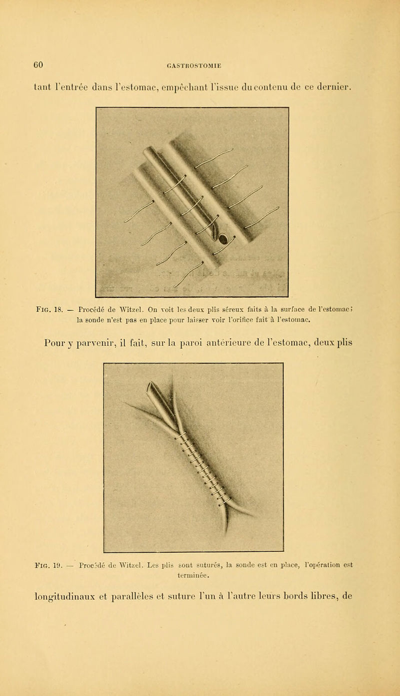 laiit l'c'uli'(k' diins l'c^stoiniU', em]ii''i'li;iuf Tissin' iluciuilcuii dr ce dernier ^' \»L % ^ ^ L 11 ^-^ \ K ■y ' < % w-^ y '-Te^lB^ ^C ^ y* ^jt '^^/ ^ ^/ ^ Fio. 18. — Procédé de Witzel. On roit les deux plis séreux faits à la surface de l'cstoiiiac; la sonde n'est pas en place pour laisser voir l'orifice fait à l'estomac. Pour y parvenir, il fait, sur la paroi antérieure de restomac, deux plis FiG. 10. — Prooklé de Witzel. Les plis sont suturés, la soude est en pli\ce, l'opéralion est terminée. longitudinaux et parallèles et suture l'un à Tautrc leurs bords libres, de