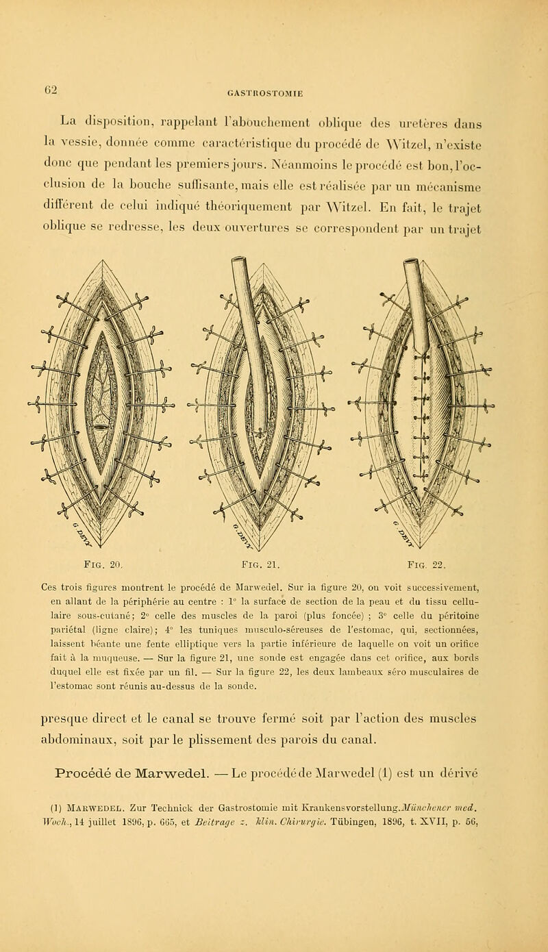 (;ASrilOSTOMIE La di-sposition, rappelant raboutliciiieiit iiljlicpic des urclrrcs dans la vessie, donnée comme caracli'i-isliqne du proe('(lé de \\'ilzel, n'existe donc qne pendant les premiers jours. Néanmoins le procédé est bon,roc- clnsion de la bouche sulfisantc, mais elle est réalisée par un mécanisme difl'érenl de celui indiqué théoriquement par Witzel. En fnit, le trajet oblique se redresse, les deux ouvertures se correspondent par un ti'ajet FiG. 21 FiG. 22. Ces trois figures inoutrent le procédé de Marwedel. Sur ia figure 20, ou voit successivement, en allant de la périphérie au centre : 1° la surface de section de la peau et du tissu cellu- laire sous-cutané; 2° celle des muscles de la paroi (plus foncée) ; 3° celle du péritoine pariétal (ligne claire); 4 les tuniques musculo-séreuses de l'estomac, qui, sectionnées, laissent héante une fente ellii^tique vers la partie intérieure de laquelle on voit un orifice fait à la muqueuse. — Sur la figure 21, une sonde est engagée dans cet orifice, aux bords duquel elle est fixée par un fil. — Sur la figure 22, les deux lambeaux séro musculaires de l'estomac sont réunis au-dessus de la soude. prescjue direct et le canal se trouve fermé soit par Faction des muscles abdominaux, soit par le plissement des parois du canal. Procédé de Mar^wedel. — Le procédé de ^larwedel (1) est un dérivé (1) Maewedel. Zur 'l'echnick der Gastrostomie mit Kraukensvorstellung.J/«M<7/eKfir jhc;^. Wuck., 14 juillet 1896, p. 6(j5, et Beitrage z. Win. Chirurgie. Tiibingen, 1896, t. XVII, p. 66,