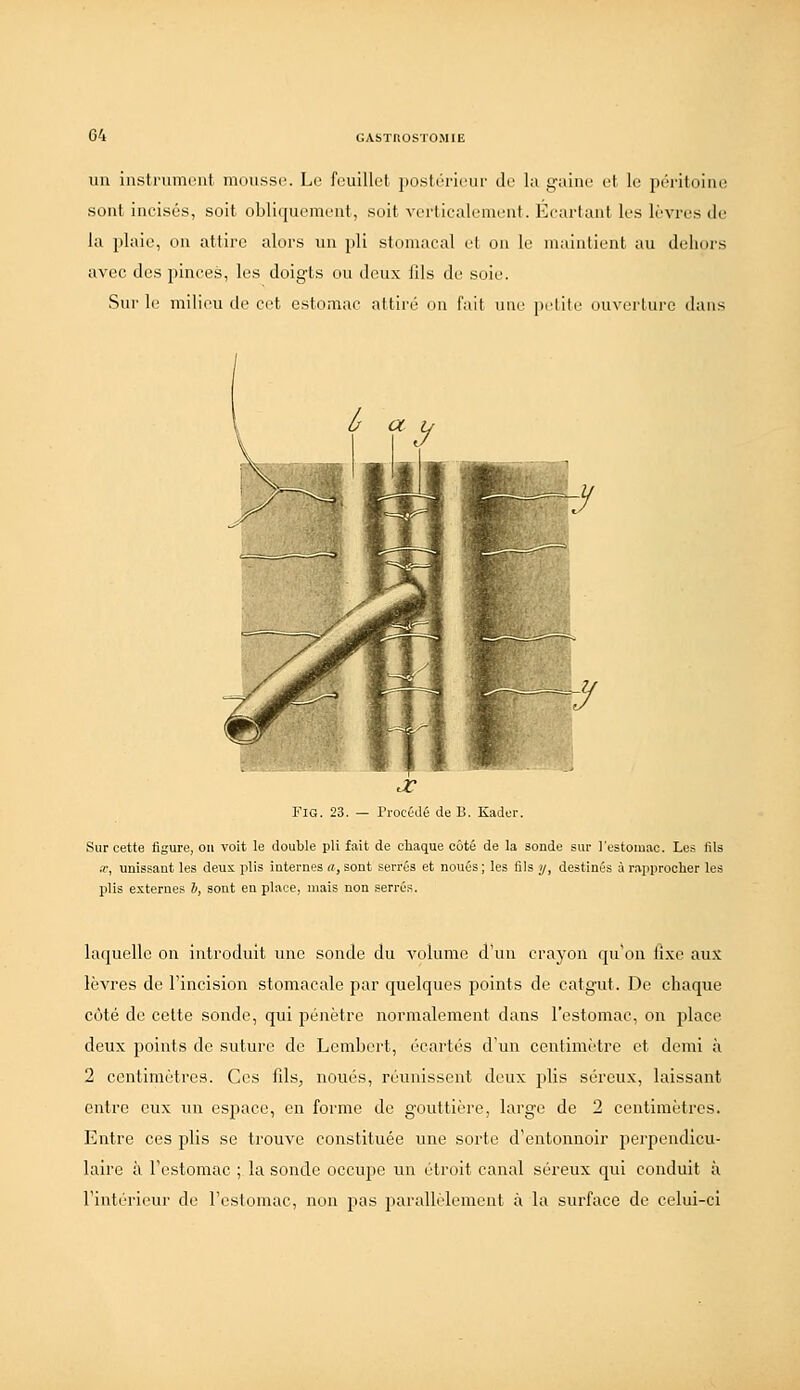 un insti'umciit imiussc. Le feuillet posléricur de la yaine el le péritoine sont incisés, soit obli(|uement, soit verticalement. Ecartant les lèvres de la plaie, on attire alors un pli stomacal et on le inaiulient au deliors avec des pinces, les doigts ou doux fds de suie. Sur le milieu de cet estomac attiré ou fait une petite ouverture dans Fia. 23. — Procédé de B. Kader. Sur cette figure, ou voit le double pli fait de chaque côté de la sonde sur l'estomac. Les fils tr, unissant les deux plis internes a, sont serrés et noués ; les fils y, destinés à rapprocher les plis externes b, sont en place, mais non serrés. laquelle on introduit une sonde du volume d'un crayon (pi'on lixe aux lèvres de l'incision stomacale par quelques points de catgut. De chaque côté de cette sonde, qui pénètre normalement dans l'estomac, on place deux points de suture de Lcmbert, écartés d'un centimètre et demi à 2 centimètres. Ces fds, noués, réunissent deux plis séreux, laissant entre eux un espace, en forme de gouttière, large de 2 centimètres. Entre ces plis se trouve constituée une sorte d'entonnoir perpendicu- laire à l'estomac ; la sonde occupe un étroit canal séreux qui conduit à l'intérieur de l'estomac, non pas parallèlement à la surface de celui-ci