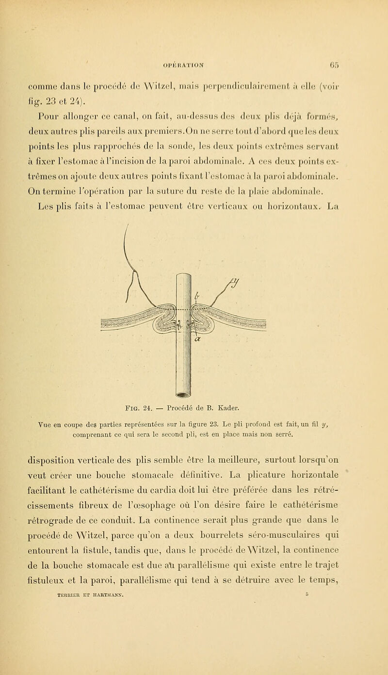 (K)min(! (I;nis l(! pi'0(!i;(l('! ilr, VV'ilzi'l, miiis ]i(!i'|)(;ii(lii',iil;iiri;iii(;iil, ;i iillc (voir- Jig. 23 et 2/j). Pour allongor ce canal, on fait, au-dessus dos doux plis d(;jà formi-s, deux autres ]ilis |)ai'eilH aux pr(!miei'S.On ne serre tout d'aljord que l(;s «Jeux points l(^s ]ihis i';ip|iri)('li«''S d(; la sonde, les deux poiuls (^\trênles servant à fixer l'estomac à l'incision de la paroi abdominale. A ces deux points ex- trêmes on ajoute; deux autres points fixant l'estomac à la j)aroi abd(jminale. On termine l'opération par la suture du l'este lie la plaie abdominale. Les plis fails à l'estomac peuvent être verticaux ou horizontaux. La FiG. 24. — Procédé de B. Kader. Vue en coupe des parties représentées sur la figure 23. Le pli profond est fait, un fil y, comprenant ce qui sera le second pli, est en place mais non serré. disposition verticale des plis semble être la meilleure, surtout lorsqu'on veut créer une bouche stomacale définitive. La plicature horizontale facilitant le cathétérisme du cardia doit lui être préférée dans les rétré- cissements fibreux de l'œsophage où l'on désire faire le cathétérisme rétrograde de ce conduit. La continence serait plus grande que dans le procédé de Witzel, parce qu'on a deux bourrelets séro-musculaires qui entourent la fistule, tandis que, dans le procédé de Witzel, la continence de la bouche stomacale est due ali paralléhsme qui existe entre le trajet fistuleux et la paroi, parallélisme qui tend à se détruire avec le temps, TERRIER ET H^VRTMANX.