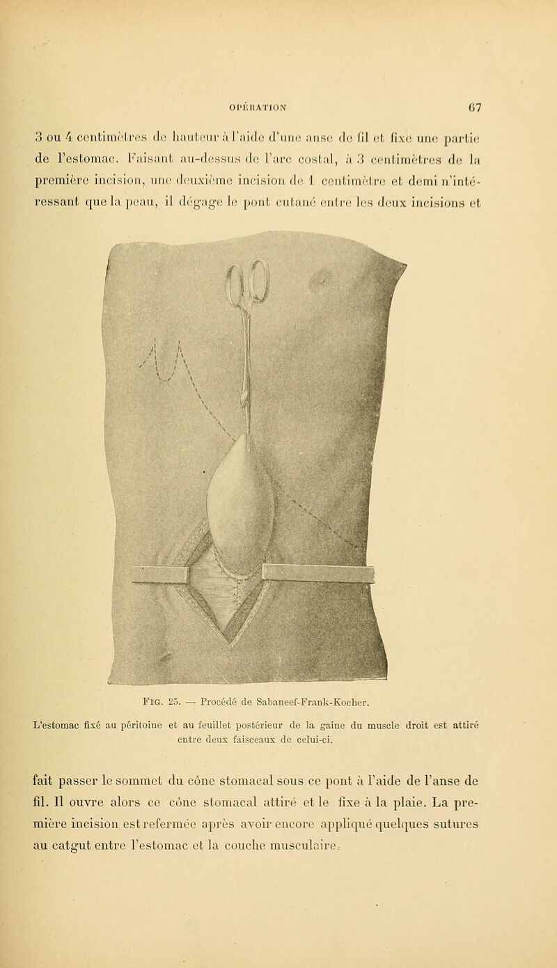 3 OU 4 CGiitiiiiMrcs i\c liiiiil-i'iir î'i l'.'iidc d'iiin';iiisr di! (il cl, fivi' mir jKiillf de Festomai'. Kaisaul aii-dcssiis du Tari' cosLal, à .'i (■ciil.iiiii-l-i'cs di; la première incision, une deuxième incision d(^ 1 conlinicLrc et demi n'inté- ressant (pn; la |)(niii, il (l('i^'ag(^ le pont cntan('; (;nti'e les di'nx incisions et Fro. 25. — rroCL'ilO rrùFlMllk-K.irl L'estomac fixé au péritoine et au feuillet postérieur de la gaine du muscle droit est attiré entre deux faisceaux de celui-ci. fait passer le sommet du cône stomacal sous ce pont à Taide de l'anse de fil. Il ouvre alors ce cône stomacal attiré et le fixe à la plaie. La pre- mière incision est refermée après avoir encore aiipliqué quelques sutures au cat2'ut entre rcslomac et la couche musculaire.