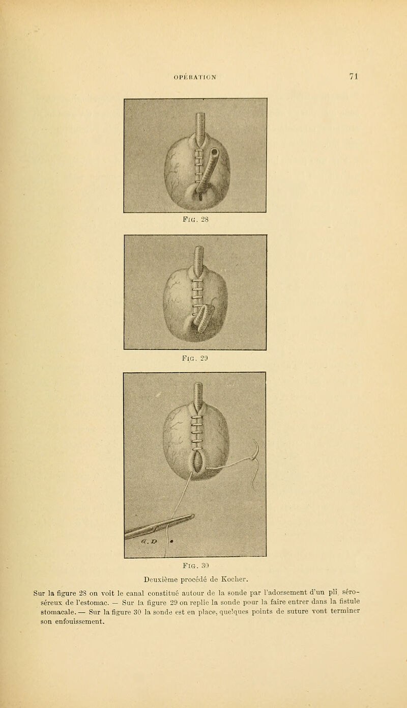 \^ FiG. ;ï'| Deuxième procédé de Koclier. Sur la figure 28 on voit le canal constitué autour de la sonde par l'adossement d'un pli séro- séreux de l'estomac. — Sur la figure 29 on replie la sonde pour la faire entrer dans la fistule stomacale.— Sur la figure 30 la sonde est en place, quelques points de suture vont terminer son enfouissement.
