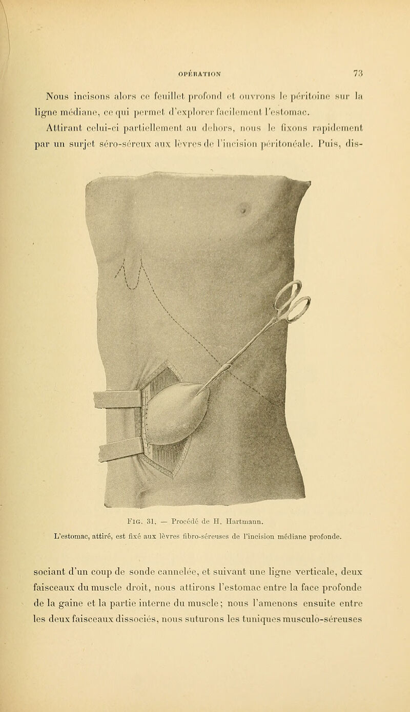 Nous incisons nlors ce, fci,iill(!l, pr(i('i)ii(l cl (iii\toiis Ii^ [x'riloini' siii' lu ligne moidianc, rf qui iicrrnni, (]V!X[)l()rri' l'iii'ilciin'iil ['rslriinac. Attiriinl, (•cliii-ci pailiclli'nH'iil an di'lioi's, rions lo fixons rajiidrnn'hl, par nn sni'ji'l S(''i'o-S(''r('.n\' anx. I^ntcs ilc l'incision |irTilfini''alr. l'nis, dis- Fu;. 31. — Procùaù do II. llaituiaiiu. L'estomac, attiré, est fixé aux 16vres fibro-séreuses de l'incision médiane profonde. sociant d'un coup de sonde cannelée, et suivant une ligne verticale, deux faisceaux du muscle droit, nous attirons Festomac entre la face profonde de la gaine et la partie interne du muscle; nous l'amenons ensuite entre les deux faisceaux dissociés, nous suturons les tuniques musculo-séreuses