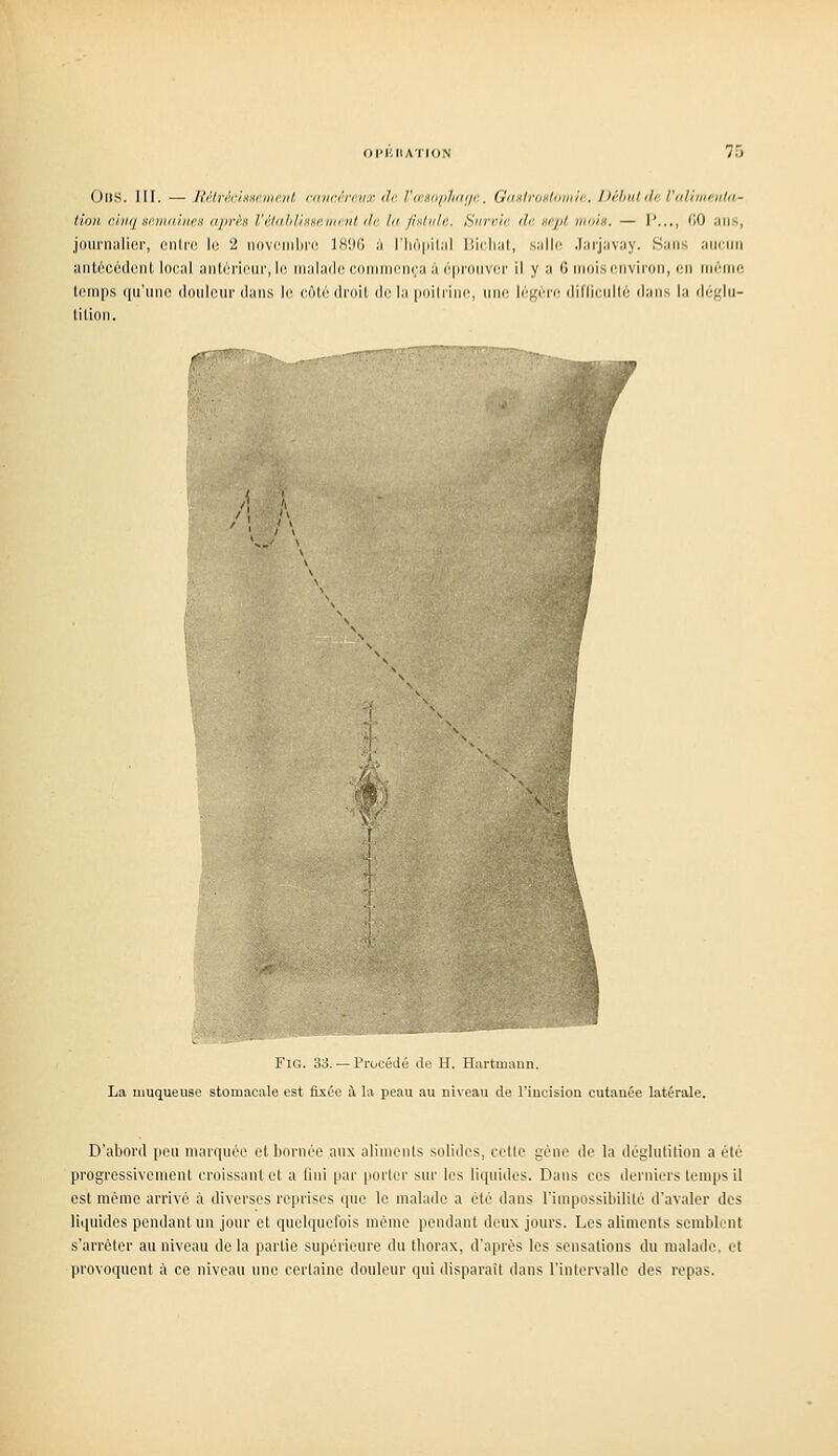OlJS. III. — JUtréciHHcmeut crmcérmio; di: l'œaophnr/e, GaHlronlomin. Débulda l'aUmenta- tioH cinq Ho.ma'mes aprè.8 l'étahlisgemiint de la fixlide. Survie de eejjl mois. — P..., GO ans, jounialicr, cnlro le 2 novcnil)rc 1890 à l'Iu'ipiliil Bioliat, salir; .larjavay. Sans aucun ant6ccdcnt local antôrioiii', le malade coniinen(;a à éprouver il y a 6 mois environ, en mémo leinps (pi'iiiie ilniilcm' dans le côté dreil de la poilrine, une léfçére diKienlté dans la déglu- lilinii. '\ !. I i FiG. :«. —Procédé a>- II. IlartiiKiim. La muqueuse stomacale est fixée à la peau au niveau de l'incision cutanée latérale. D'aboi'd pen marquée et bornée aux aliments solides, cotte gène de la déglutition a été progressivement croissant et a fini par porter snr les liquides. Dans ces derniers temps il est même arrivé à diverses reprises que le malade a été dans l'impossibilité d'avaler des liquides pendant un jour et quelquefois même pendant deux jours. Les aliments semblent s'arrêter au niveau de la partie supérieure du thorax, d'après les sensations du malade, et provoquent à ce niveau une certaine douleur qui disparait dans l'intervalle des repas.