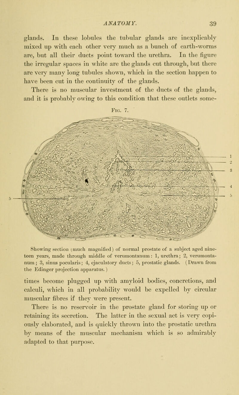 g;lands. In these lobules the tubular glands are inexplicably mixed up with each other very much as a bunch of earth-worms are, but all their ducts point toward the urethra. In the figure the irregular spaces in white are the glands cut through, but there are very many long tubules shown, which in the section happen to have been cut in the continuity of the glands. There is no muscular investment of the ducts of the glands, and it is probably owing to this condition that these outlets some- FiG. 7. -iix- X-i . CyX^i J L&y o'X Showing section (^much magnified) of normal prostate of a subject aged nine- teen years, made through middle of verumontanum: 1, urethra; 2, verumonta- num ; 3, sinus pocularis; 4, ejaculatory ducts ; 5, prostatic glands. (Dra^vn from the Edinger projection apparatus.) times become plugged up with amyloid bodies, concretions, and calculi, which in all probability would be expelled by circular muscular fibres if they were present. There is no reservoir in the prostate gland for storing up or retaining its secretion. The latter in the sexual act is very copi- ously elaborated, and is quickly thrown into the prostatic urethra by means of the muscular mechanism which is so admirably adapted to that purpose.