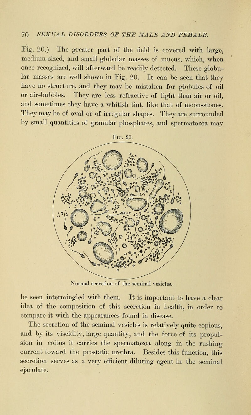 Fig. 20.) The greater part of the field is covered with large, medium-sizedj and small globular masses o£ mucus, which, when once recognized, will afterward be readily detected. These globu- lar masses are well shown in Fig. 20. It can be seen that they have no structure, and they may be mistaken for globules of oil or air-bubbles. They are less refractive of light than air or oil, and sometimes they have a whitish tint, like that of moon-stones. They may be of oval or of irregular shapes. They are surrounded by small quantities of granular phosphates, and spermatozoa may Fig. 20. Normal secretion of the seminal vesicles. be seen intermingled with them. It is important to have a clear idea of the composition of this secretion in health, in order to compare it with the appearances found in disease. The secretion of the seminal vesicles is relatively quite copious, and by its viscidity, large quantity, and the force of its propul- sion in coitus it carries the spermatozoa along in the rushing current toward the prostatic urethra. Besides this function, this secretion serves as a very efficient diluting agent in the seminal ejaculate.