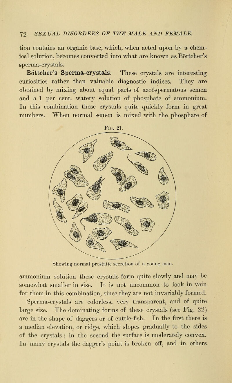 tion contains an organic base, which, when acted upon by a chem- ical solution, becomes converted into what are known as Bottcher's sperma-crjstals. Bottcher's Sperma-crystals. These crystals are interesting curiosities rather than valuable diagnostic indices. They are obtained by mixing about equal parts o£ azoospermatous semen and a 1 per cent, watery solution of phosphate of ammonium. In this combination these crystals quite quickly form in great numbers. When normal semen is mixed with the phosphate of Fig. 21. Showing normal prostatic secretion of a young man. ammonium solution these crystals form quite slowly and may be somewhat smaller in size. It is not uncommon to look in vain for them in this combination, since they are not invariably formed. Sperma-crystals are colorless, very transparent, and of quite large size. The dominating forms of these crystals (see Fig. 22) are in the shape of daggers or of cuttle-fish. In the first there is a median elevation, or ridge, which slopes gradually to the sides of the crystals; in the second the surface is moderately convex. In many crystals the dagger's point is broken off, and in others