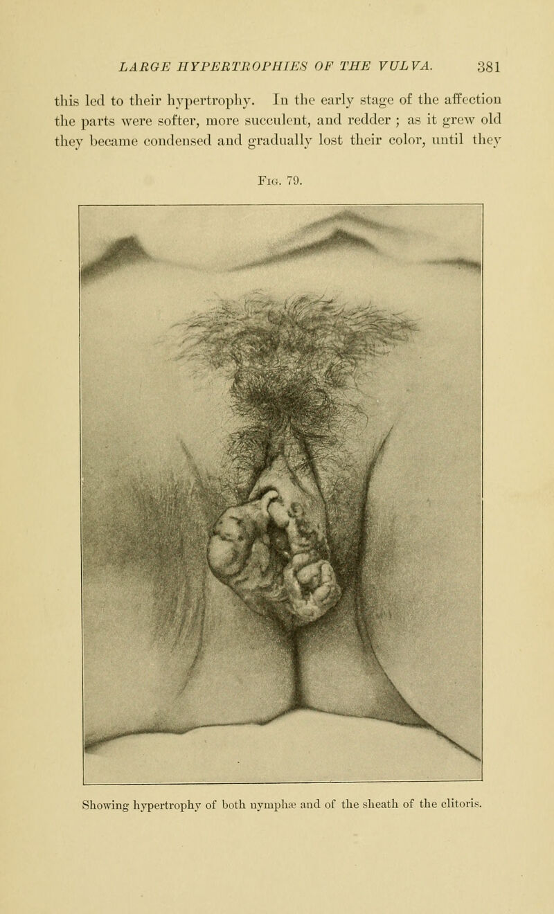 this led to their hypertrophy. In the early stage of the affection the parts were softer, more succulent, and redder ; as it grew old thev became condensed and gradually lost their color, until they Fig. 79. Showing hypertropliy of both nympha^ and of the sheath of the clitoris.