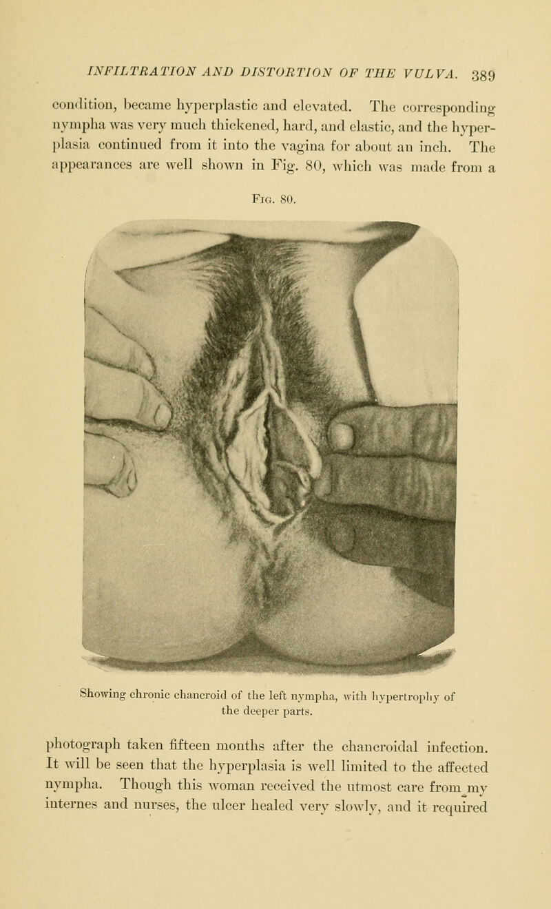 condition, became hyperplastic and elevated. The corresponding nympha was very ranch thickened, hard, and elastic, and the hyper- plasia continued from it into the vagina for about an inch. The appearances are well shoAvn in Fig. 80, which was made from a Fig. 80. Showing chronic chancroid of the left nympha, with liypertropliy of the deeper parts. photograph taken fifteen mouths after the chancroidal infection. It will be seen that the hyperplasia is well limited to the affected nympha. Though this woman received the utmost care from my internes and nurses, the ulcer healed very slowly, and it required