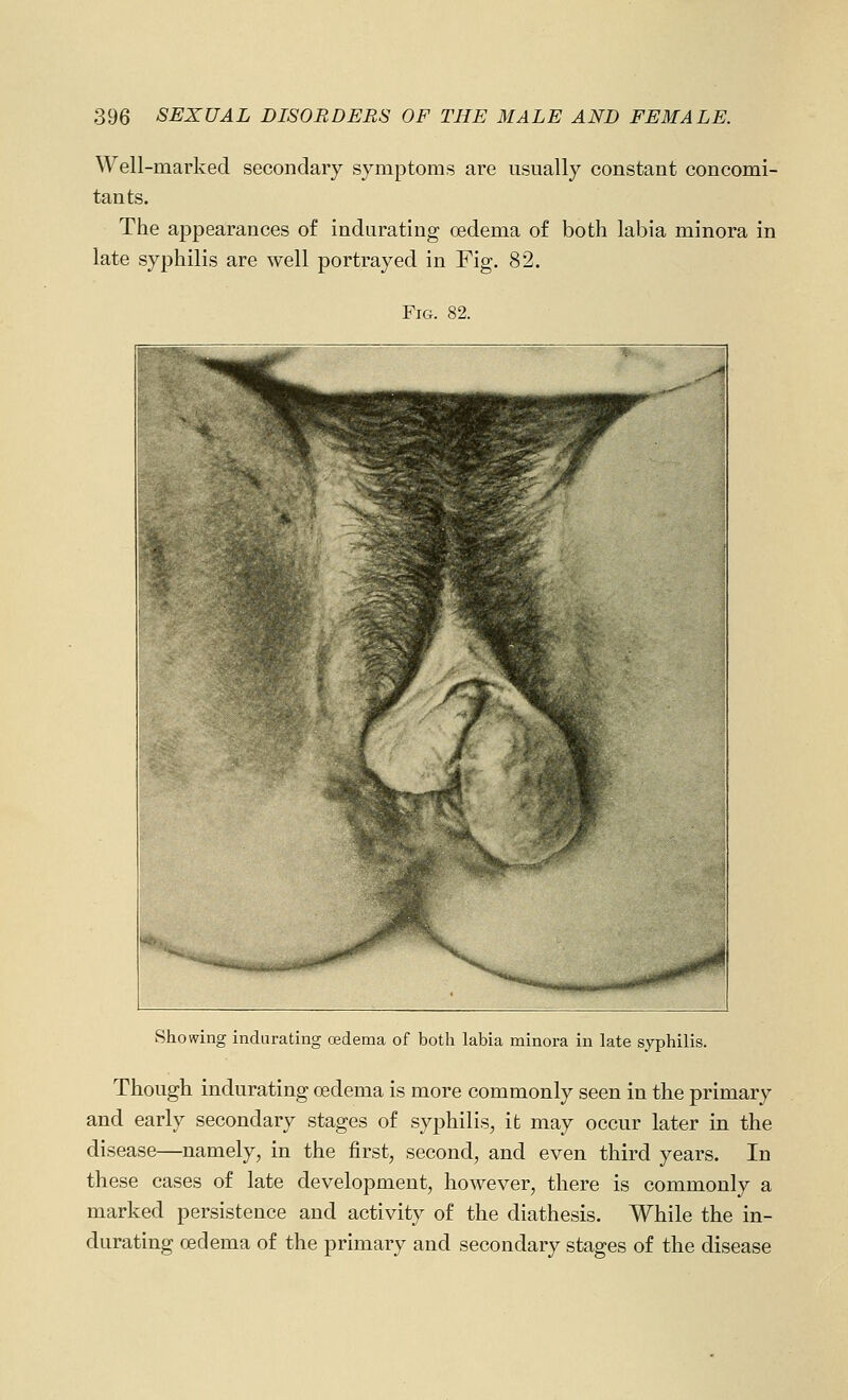 Well-marked secondary symptoms are usually constant concomi- tants. The appearances of indurating oedema of both labia minora in late syphilis are well portrayed in Fig. 82. Fig. 82. Showing indurating oedema of both labia minora in late syphilis. Though indurating oedema is more commonly seen in the primary and early secondary stages of syphilis, it may occur later in the disease—namely, in the first, second, and even third years. In these cases of late development, however, there is commonly a marked persistence and activity of the diathesis. While the in- durating oedema of the primary and secondary stages of the disease