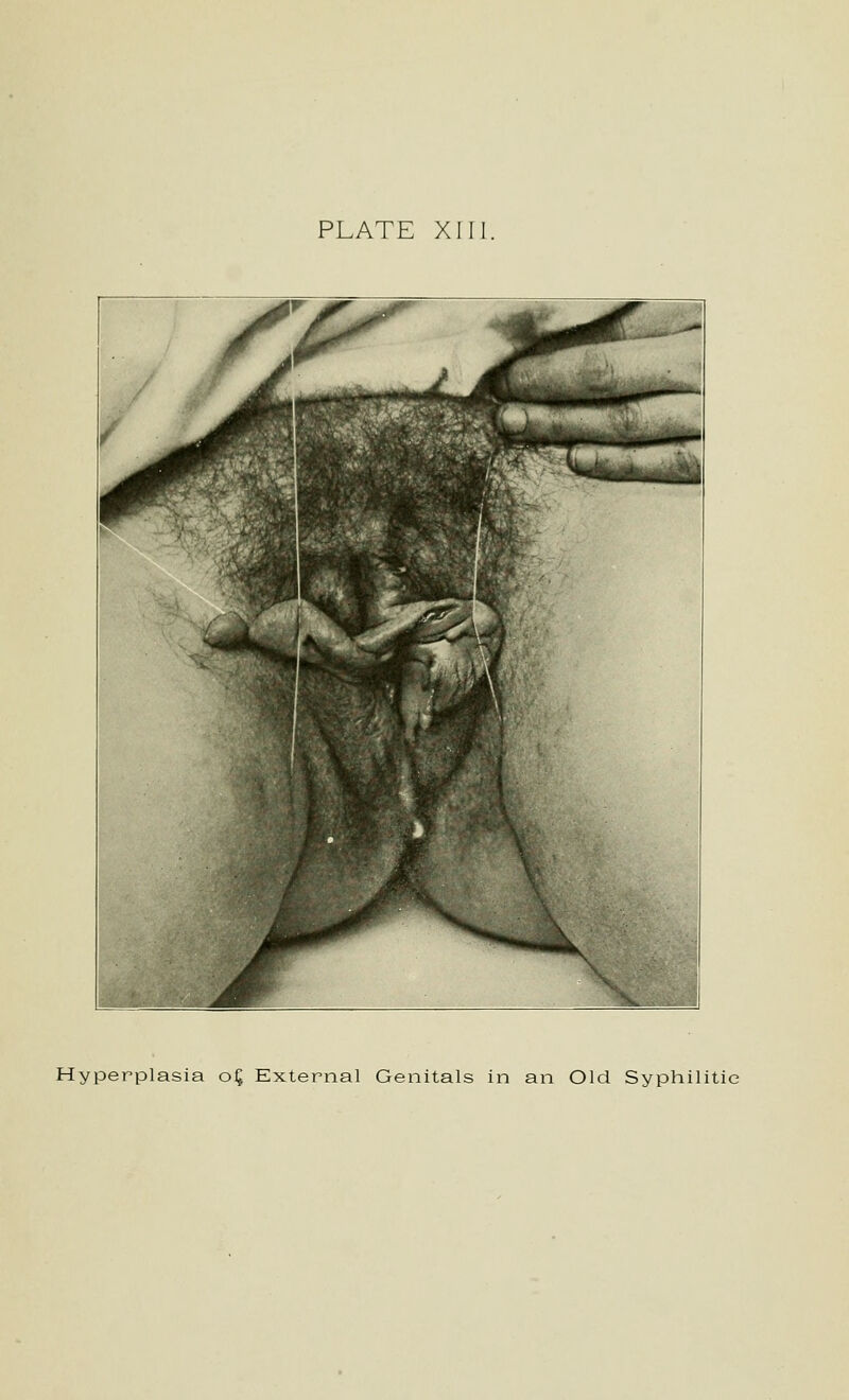 PLATE XHl, Hyperplasia o^ External Genitals in an Old Syphilitic