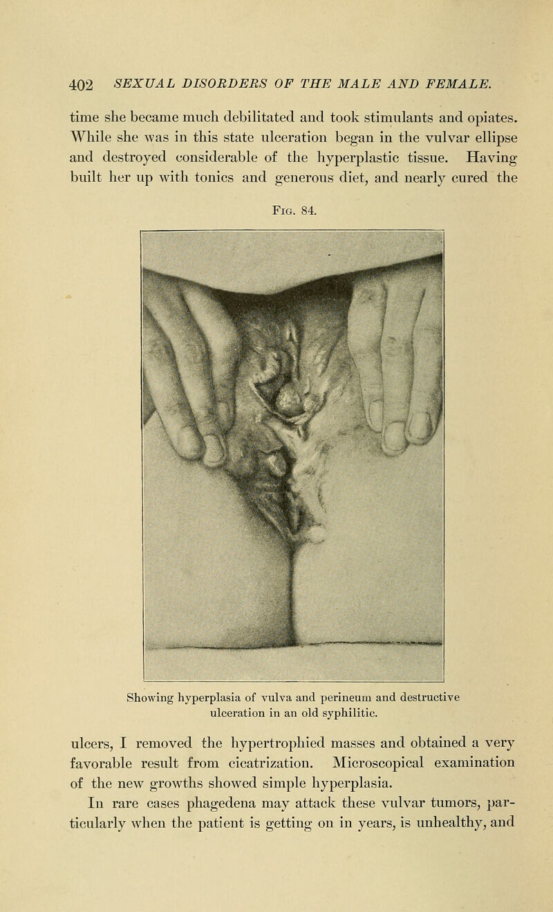 time she became much debilitated and took stimulants and opiates. While she was in this state ulceration began in the vulvar ellipse and destroyed considerable of the hyperplastic tissue. Having built her up with tonics and generous diet, and nearly cured the Fig. 84. Showing hyperplasia of vulva and perineum and destructive ulceration in an old syphilitic. ulcers, I removed the hypertrophied masses and obtained a very favorable result from cicatrization. Microscopical examination of the new growths showed simple hyperplasia. In rare cases phagedena may attack these vulvar tumors, par- ticularly when the patient is getting on in years, is unhealthy, and