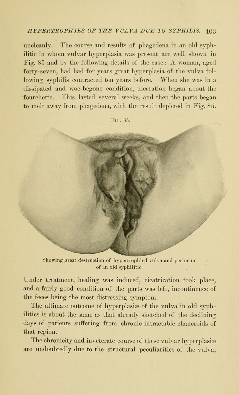 uncleanly. The course and results of phagedena in an old syph- ilitic in whom vulvar hyperplasia was present are well shown in Fig. 85 and by the following details of the case: A woman, aged forty-seven, had had for years gnjat hyperplasia of the vulva fol- lowing syphilis contracted ten years before. When she was in a dissipated and woe-begone condition, ulceration began about the fourchette. This lasted several weeks, and then the parts began to melt away from phagedena, with the result depicted in Fig. 85. Fig. 85. ¥ Showing great destruction of hyperiropliied vulva and perineum of an old syphilitic. Under treatment, healing was induced, cicatrization took place, and a fairly good condition of the parts was left, incontinence of the feces being the most distressing symptom. The ultimate outcome of hyperplasise of the vulva in old syph- ilitics is about the same as that already sketched of the declining days of patients suffering from chronic intractable chancroids of that region. The chronicity and inveterate course of these vulvar hyperplasise are undoubtedly due to the structural peculiarities of the vulva,