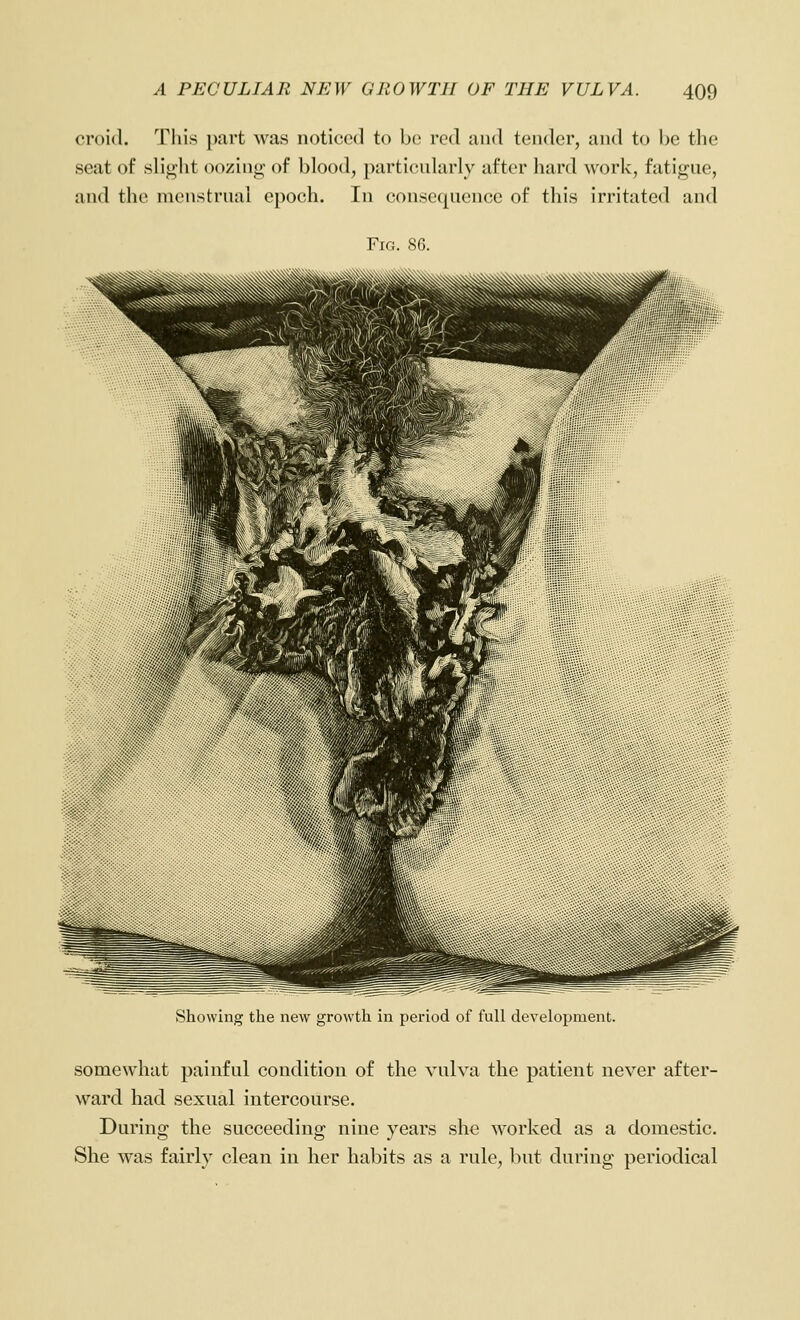 croid. Tliis part was noticed to \n\ red and tender, and to be the seat of .sli*;]it oozino- of blood, particularly after hard work, fati<^ue, and the menstrual epoch. In consequence of this irritated and Fig. 86. Showing the new growth in period of full development. somewhat painful condition of the vulva the patient never after- ward had sexual intercourse. During the succeeding nine years she worked as a domestic. She was fairly clean in her habits as a rule, but during periodical