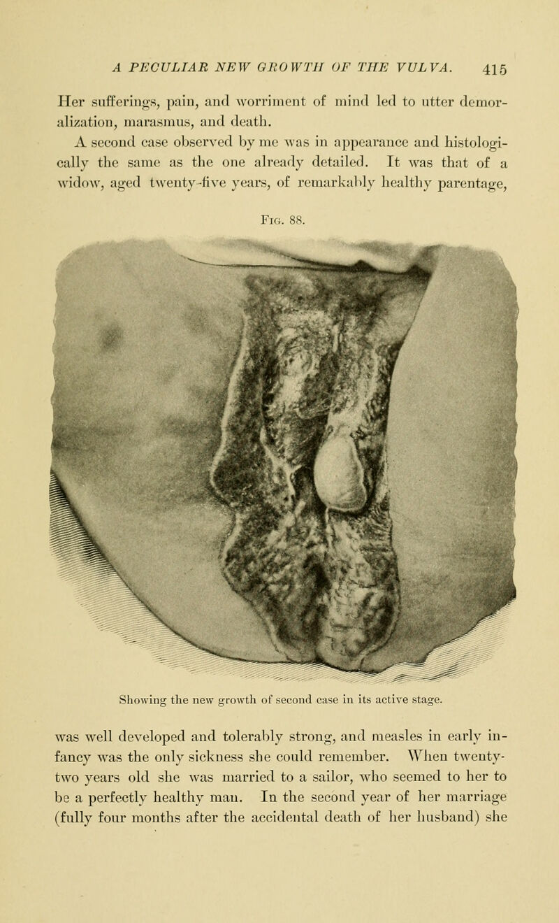 Her sufferings, paiu, and worriincnt of mind led to utter demor- alization, marasmus, and death. A second case observed by me Avas in appearance and histologi- cally the same as the one already detailed. It was that of a widow, aged twenty five years, of remarkably healthy parentage. Fig. 88. Showing the new growth of second case in its active stage. was well developed and tolerably strong, and measles in early in- fancy was the only sickness she could remember. When twenty- two years old she was married to a sailor, who seemed to her to be a perfectly healthy man. In the second year of her marriage (fully four months after the accidental death of her husband) she