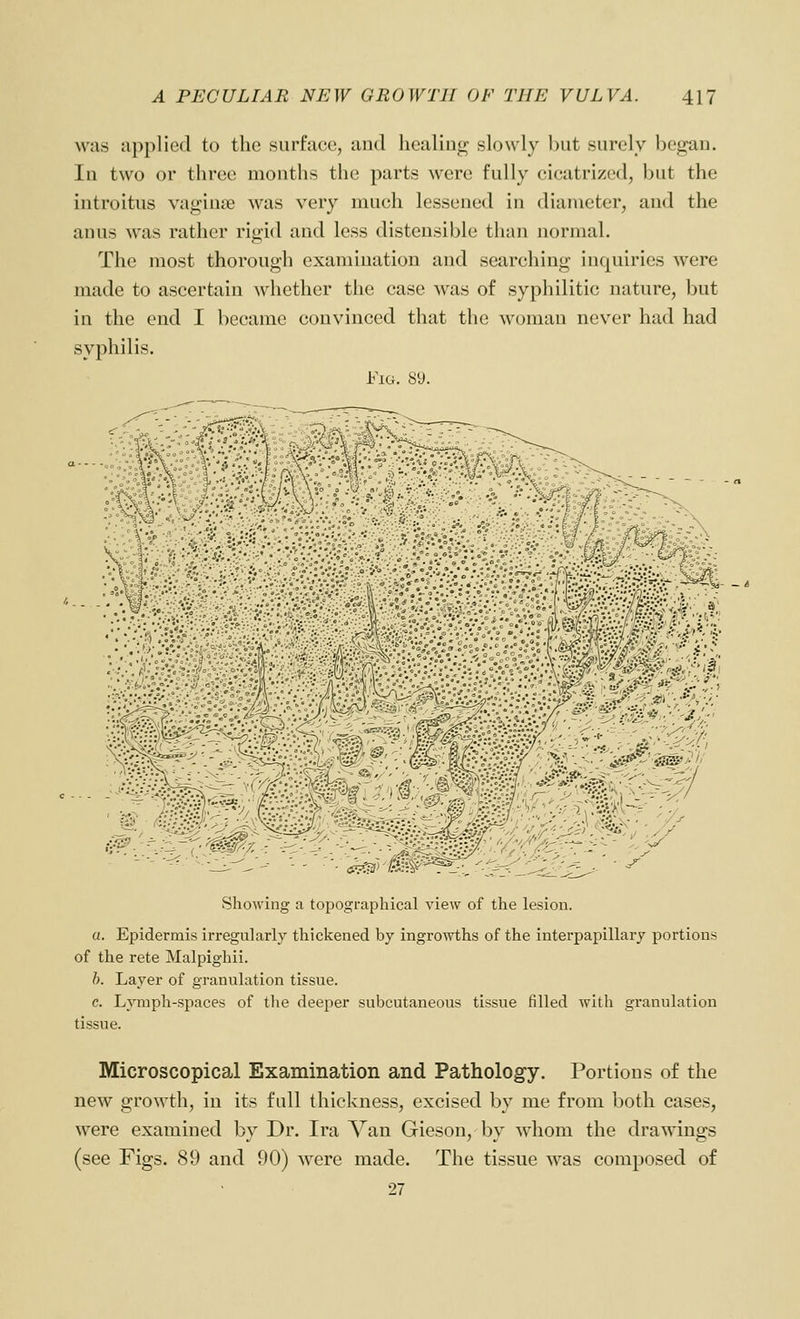 was applied to the surface, and healing slowly hut surely hegau. In two or three months the parts were fully cicatrized, but the introitus vaginae Avas very much lessened in diameter, and the anus was rather riojid and less distensible than normal. The most thorough examination and searching inquiries were made to ascertain whether the case was of syphilitic nature, but in the end I became convinced that the woman never had had syphilis. FiG. 89. ■ y Showing a topographical view of the lesion. a. Epidermis irregularly thickened by ingrowths of the interpapillary portions of the rete Malpighii. h. Layer of granulation tissue. c. LjTuph-spaces of tlie deeper subcutaneous tissue filled with granulation tissue. Microscopical Examination and Pathology. Portions of the new growth, in its full thickness, excised by me from both cases, were examined by Dr. Ira Van Gieson, by whom the drawings (see Figs. 89 and 90) were made. The tissue was composed of 27