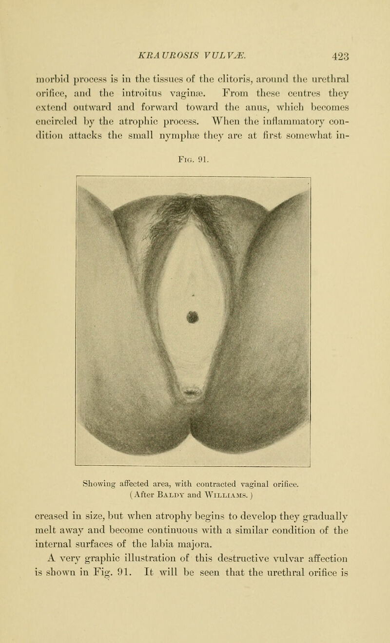 morbid process is in the tissues of the clitoris, aronnd the urethral orifice, and the introitus vagime. From these centres they extend outward and forward toward the anus, which l^ecomes encircled l)y the atrophic process. When the inHammatorj con- dition attacks the small nymphse they are at first somewhat in- Fk;. m. Showing affected area, with contracted vaginal orifice. (After Baldy and Williams. ) creased in size, l^ut when atrophy begins to develop they gradually melt away and become continuous with a similar condition of the internal surfaces of the labia majora. A very graphic illustration of this destructive vulvar affection is shown in Fig. 91. It will be seen that the urethral orifice is