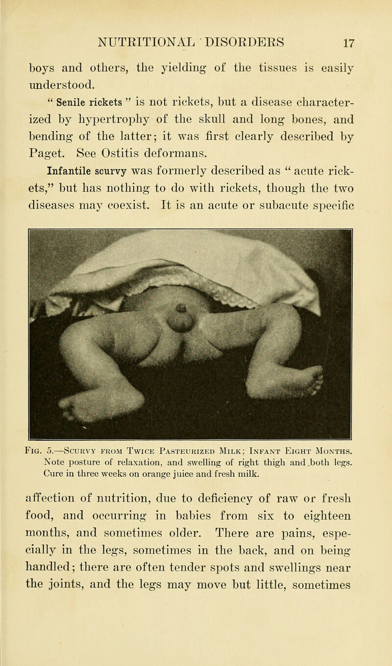 boys and others, the yielding of the tissues is easily understood.  Senile rickets  is not rickets, but a disease character- ized by hypertrophy of the skull and long bones, and bending of the latter; it was first clearly described by Paget. See Ostitis deformans. Infantile scurvy was formerly described as  acute rick- ets, but has nothing to do with rickets, though the two diseases may coexist. It is an acute or subacute specific Fig. 5.—Scurvy from Twice Pasteurized Milk; Infant Eight Months. Note posture of relaxation, and swelling of right thigh and .both legs. Cure in three weeks on orange juice and fresh milk. affection of nutrition, due to deficiency of raw or fresh food, and occurring in babies from six to eighteen months, and sometimes older. There are pains, espe- cially in the legs, sometimes in the back, and on being handled; there are often tender spots and swellings near the joints, and the legs may move but little, sometimes