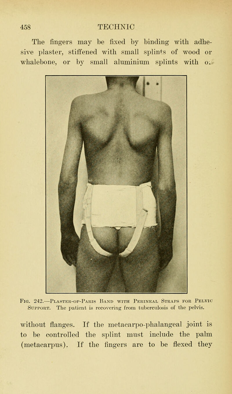 The fingers may be fixed by binding with adhe- sive plaster, stiffened with small splin+s of wood or whalebone, or by small aluminium splints with Ox Fig. 242.—Plaster-of-Paris Band with Perineal Straps for Pelvic Support. The patient is recovering from tuberculosis of the pelvis. without flanges. If the metacarpo-phalangeal joint is to be controlled the splint must include the palm (metacarpus). If the fingers are to be flexed they