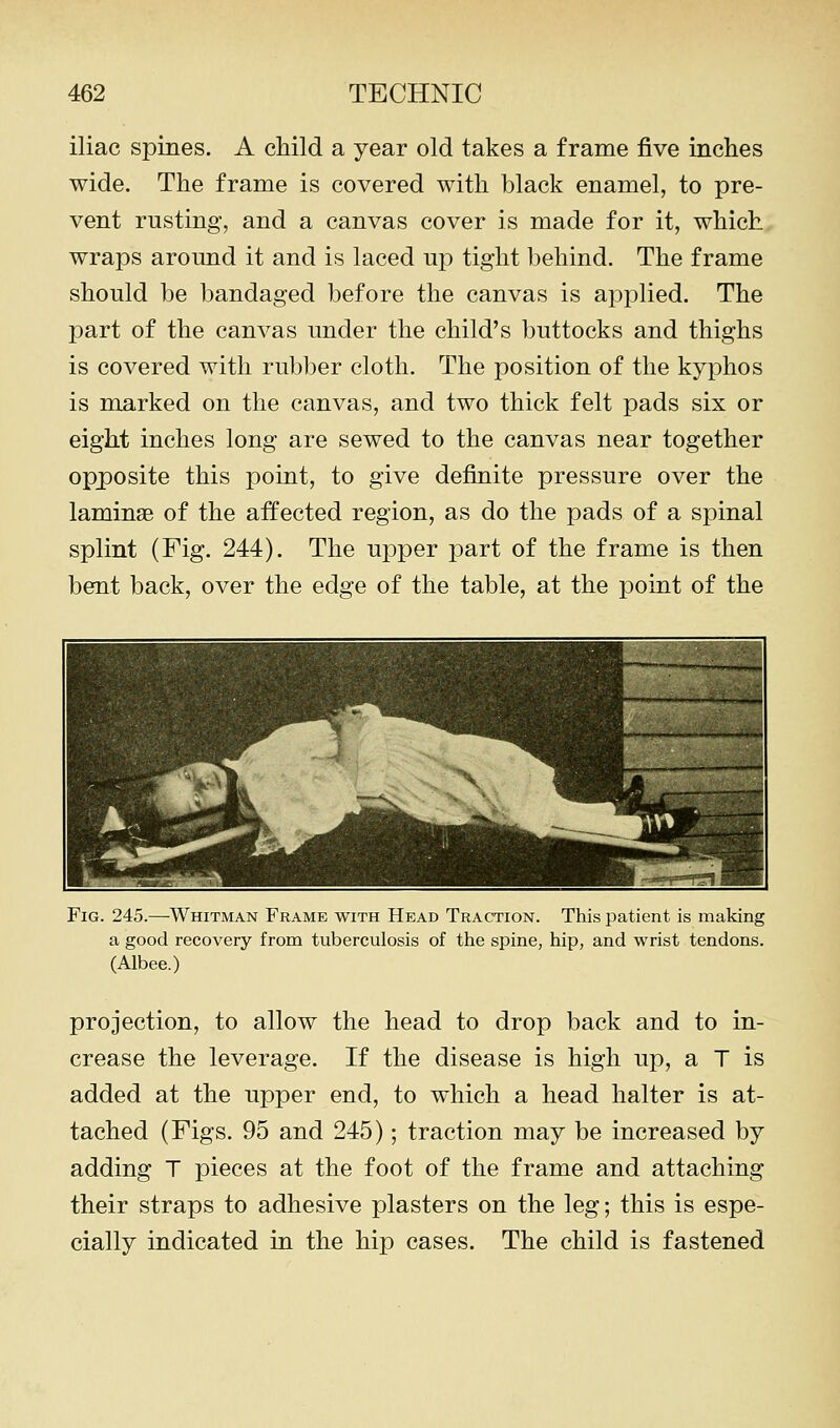 iliac spines. A child a year old takes a frame five inches wide. The frame is covered with black enamel, to pre- vent rusting, and a canvas cover is made for it, which wraps around it and is laced up tight behind. The frame should be bandaged before the canvas is applied. The part of the canvas under the child's buttocks and thighs is covered with rubber cloth. The position of the kyphos is marked on the canvas, and two thick felt pads six or eight inches long are sewed to the canvas near together opposite this point, to give definite pressure over the laminae of the affected region, as do the pads of a spinal splint (Fig. 244). The ujDper part of the frame is then bent back, over the edge of the table, at the point of the Fig. 245.—Whitman Frame with Head Traction. This patient is making a good recovery from tuberculosis of the spine, hip, and wrist tendons. (Albee.) projection, to allow the head to drop back and to in- crease the leverage. If the disease is high up, a T is added at the upper end, to which a head halter is at- tached (Figs. 95 and 245); traction may be increased by adding T pieces at the foot of the frame and attaching their straps to adhesive plasters on the leg; this is espe- cially indicated in the hip cases. The child is fastened