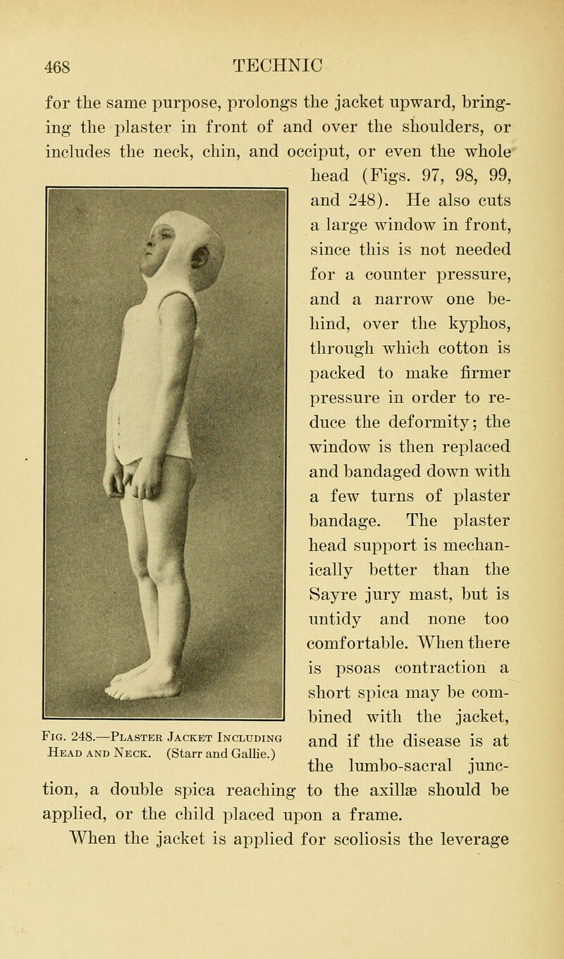 for the same purpose, prolongs the jacket upward, bring- ing the plaster in front of and over the shoulders, or includes the neck, chin, and occiput, or even the whole head (Figs. 97, 98, 99, and 248). He also cuts a large window in front, since this is not needed for a counter pressure, and a narrow one be- hind, over the kyphos, through which cotton is packed to make firmer pressure in order to re- duce the deformity; the window is then replaced and bandaged down with a few turns of plaster bandage. The plaster head support is mechan- ically better than the Sayre jury mast, but is untidy and none too comfortable. When there is psoas contraction a short spica may be com- bined with the jacket, and if the disease is at the lumbo-sacral junc- tion, a double spica reaching to the axillae should be applied, or the child placed upon a frame. When the jacket is applied for scoliosis the leverage Fig. 248.—Plaster Jacket Including Head and Neck. (Starr and Gallie.)