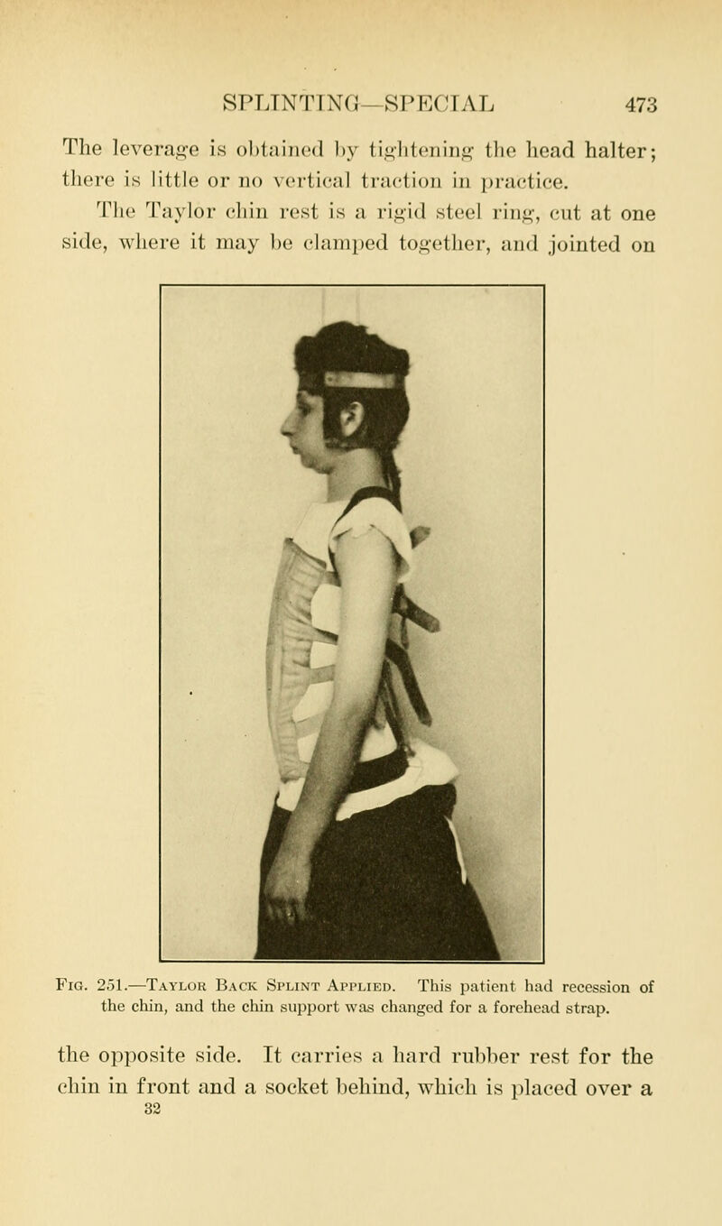 The levera,i>-e is obiaiiiod l)y ti,i^litoiiiii<2;- the liead halter; there is little or no vertical traction in ijractice. 'I'lic Taylor chin rest is a rigid steel ring, cut at one side, where it may be clamped tog-ether, and jointed on Fig. 251.—Taylor Back Splint Applied. This patient had recession of the chin, and the chin siqjport was changed for a forehead strap. the opposite side. It carries a hard rubber rest for the chin in front and a socket behind, which is placed over a 32