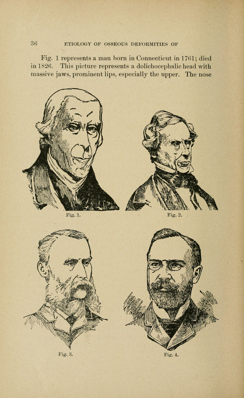 Fig. 1 represents a man born in Connecticut in 17(!1; died in 1826. This picture represents a dolicliocephalic head with massive jaws, prominent lips, especially the upper. The nose Fiff. 1. Fig. 2. Fig. .3. Fig. 4.